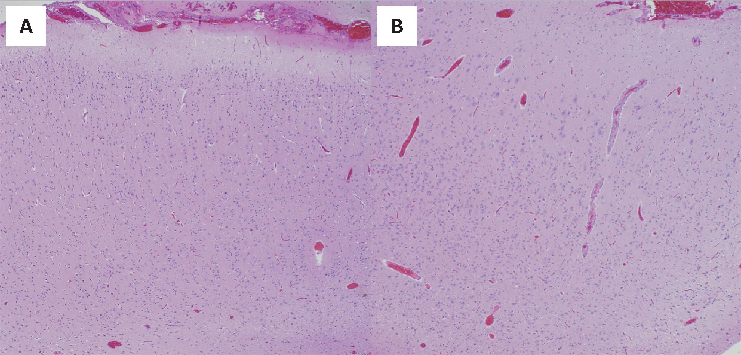 FIGURE 4.42, Focal cortical dysplasia (FCD) type 1. ( A ) FCD type Ia with abnormal radial lamination with abundant microcolumns, defined as 8 or more small-diameter neurons arranged in a column. ( B ) FCD type Ib with abnormal tangential lamination with loss of the six-layered normal isocortical architecture.