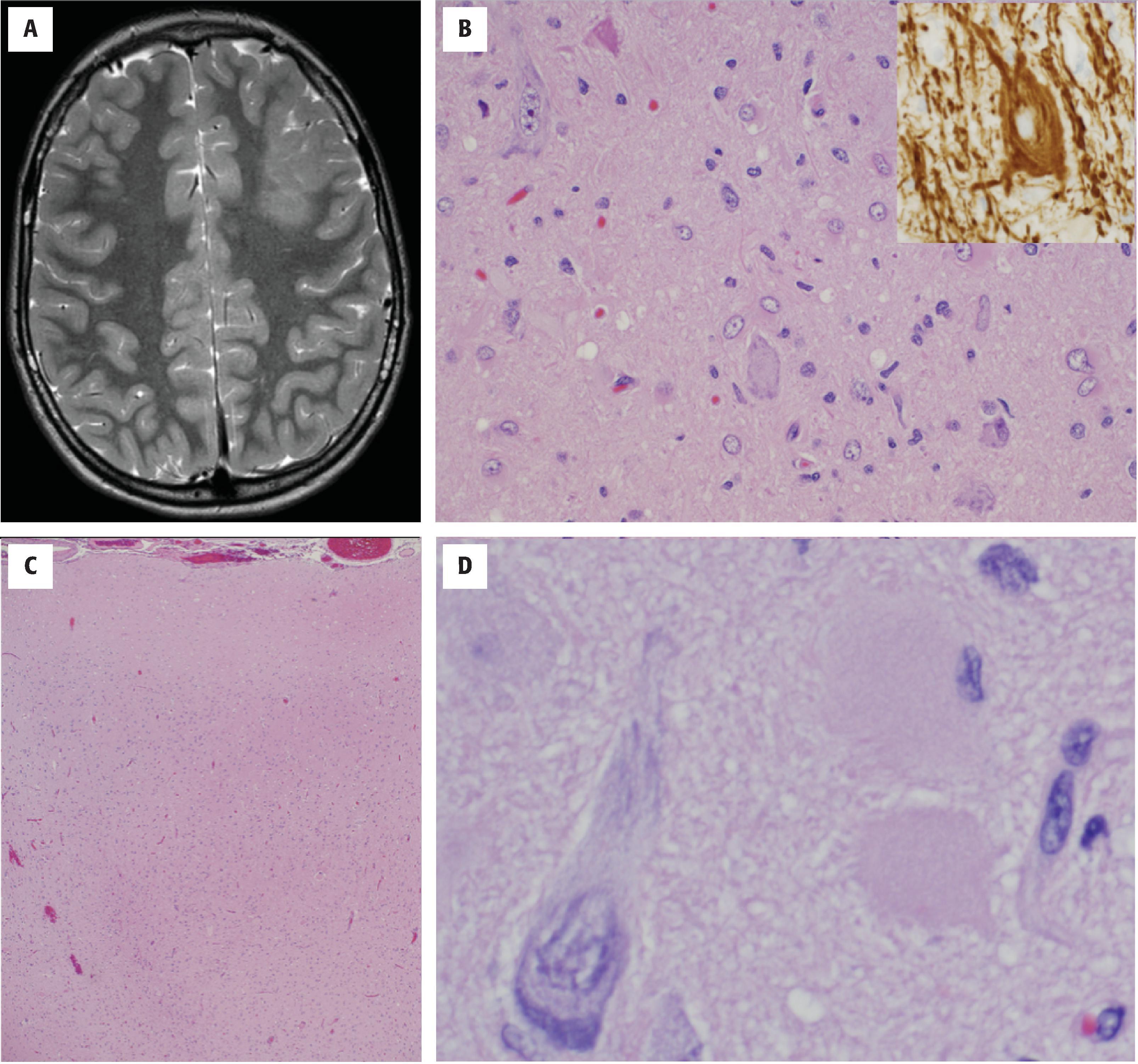 FIGURE 4.43, Focal cortical dysplasia Type 2. ( A ) Magnetic resonance imaging showing blurred gray white junction and transmantle-sign characterized by a funnel-like hyperintensity tapering from the gyrus towards the ventricle. ( B ) Hematoxylin and eosin–stained section showing large neurons with abnormal peripherally placed aggregates of Nissl substance and cytoplasmic cell body (soma) accumulation of neurofilament protein on NFP stained section—a stain that typically shows only neurite (axon, dendrite) staining. ( C ) Loss of tangential laminar architecture and blurred gray white junction in FCD type II. ( D ) Higher magnification view showing two balloon cells with abundant eosinophilic cytoplasm and eccentrically placed nucleus.