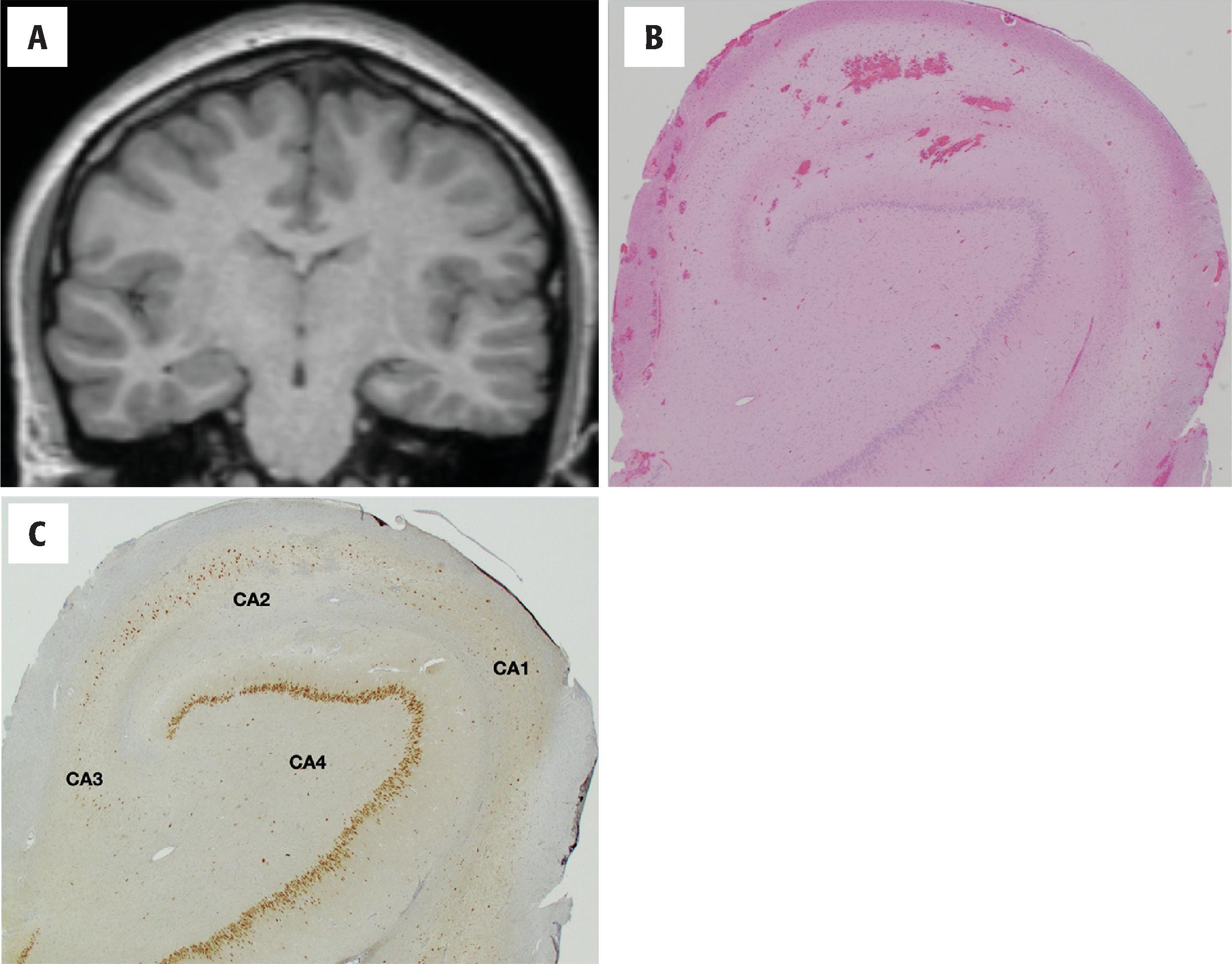 FIGURE 4.44, Hippocampal sclerosis. ( A ) Magnetic resonance imaging showing atrophy of the left hippocampus and enlargement of the temporal horn of the lateral ventricle. ( B and C ) Hematoxylin and eosin ( B ) and NeuN ( C ) immunostained section of the hippocampus demonstrating extensive neuronal loss all through the CA regions with relative preservation of the CA2 segment.