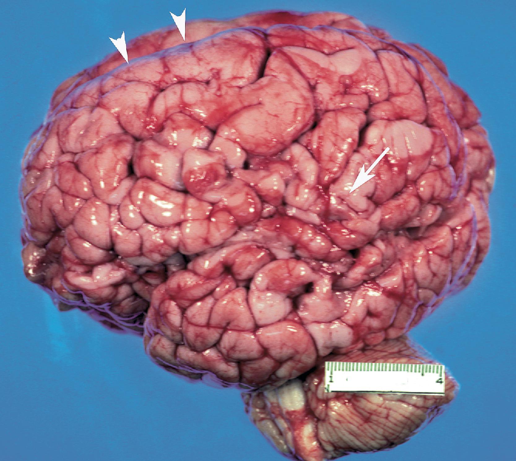 FIGURE 4.45, Zellweger’s syndrome: lateral view of the brain showing complex, small gyri (polymicrogyria) along the Sylvian fissure ( arrow ) with pachygyria along the parasagittal region ( top of the hemisphere) ( arrowheads ).