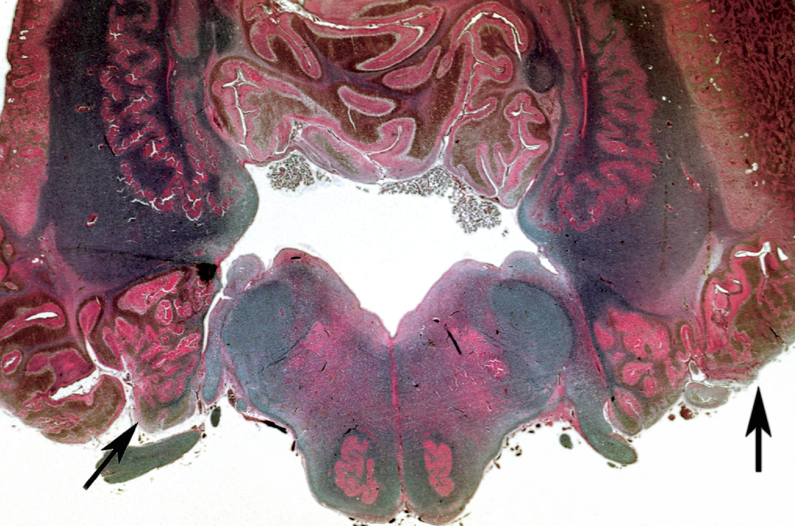 FIGURE 4.47, Cerebellum with dysplasia: transilluminated whole-mount axial section of the cerebellum and medulla demonstrating cerebellar polymicrogyria ( arrows ).