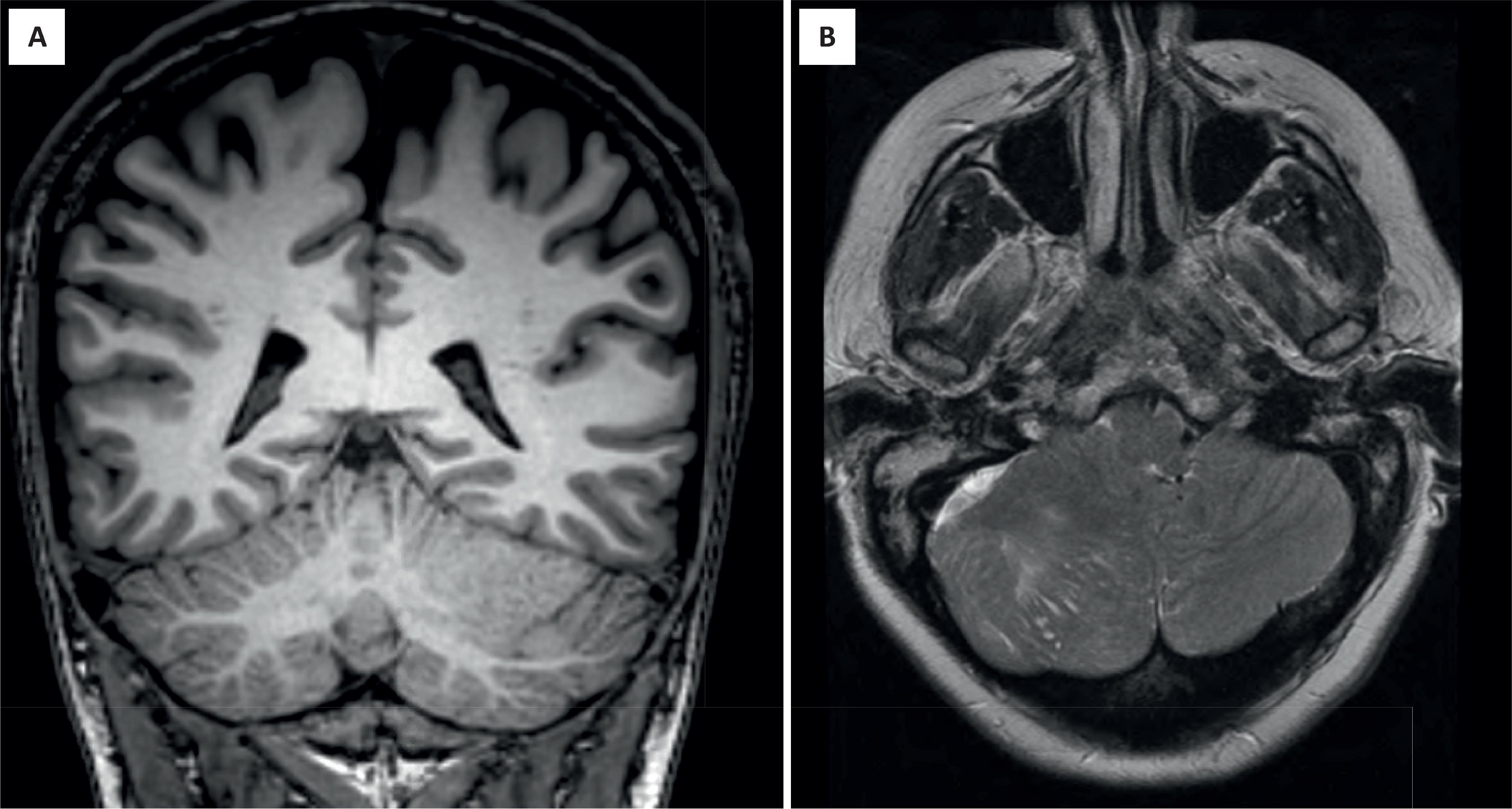 FIGURE 4.48, Dysplastic cerebellar gangliocytoma. ( A ) Magnetic resonance imaging coronal section showing a unilateral cerebellar lesion with expansion of the folia. ( B ) Axial T2-weighted image demonstrating focal, striped appearance.