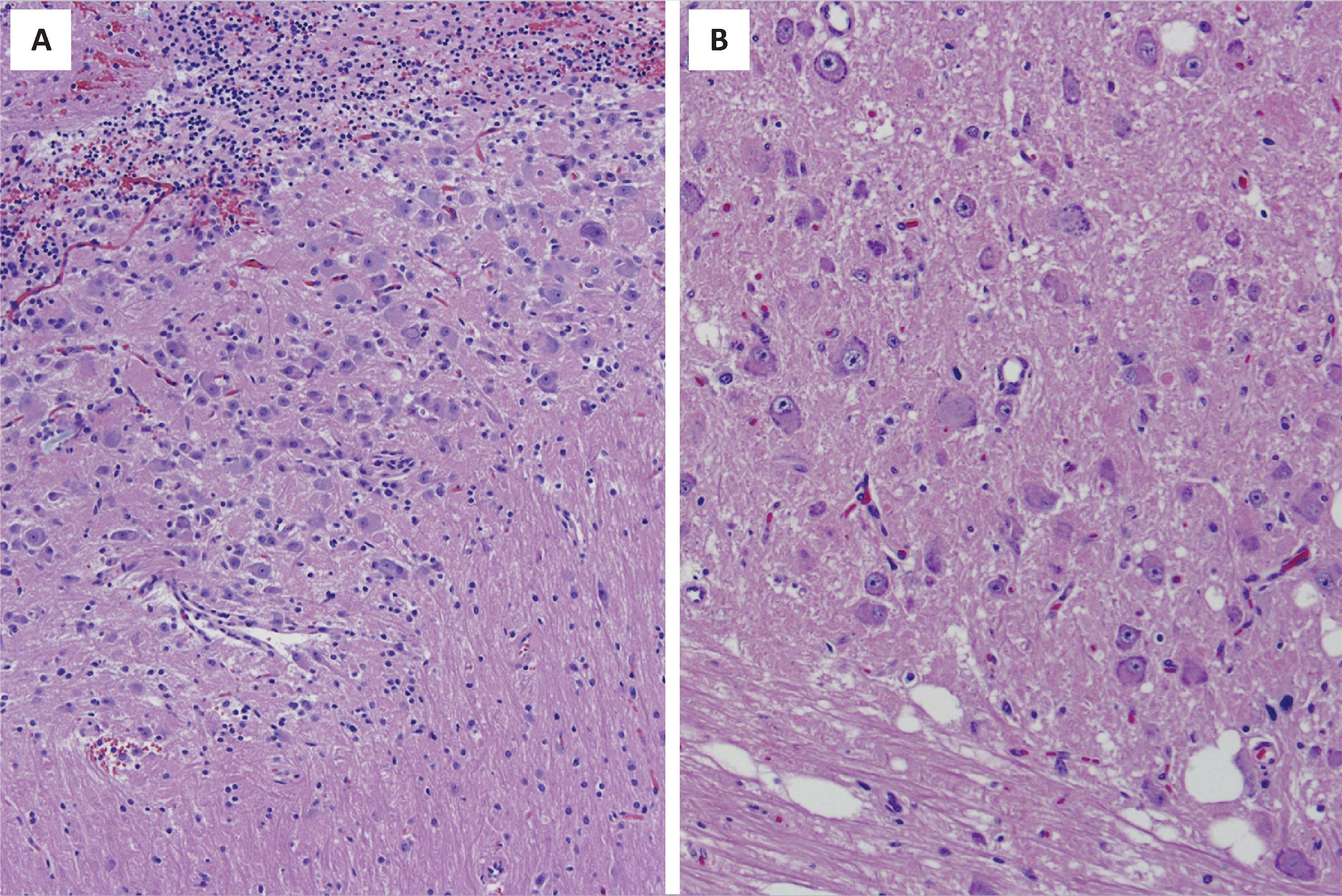 FIGURE 4.49, Dysplastic cerebellar gangliocytoma. ( A ) Partial replacement of the internal granular layer with dysplastic ganglion cells. ( B ) Higher magnification view showing dysplastic ganglion cells of varying sizes. The cerebellar white matter shows clear spaces and clefts.