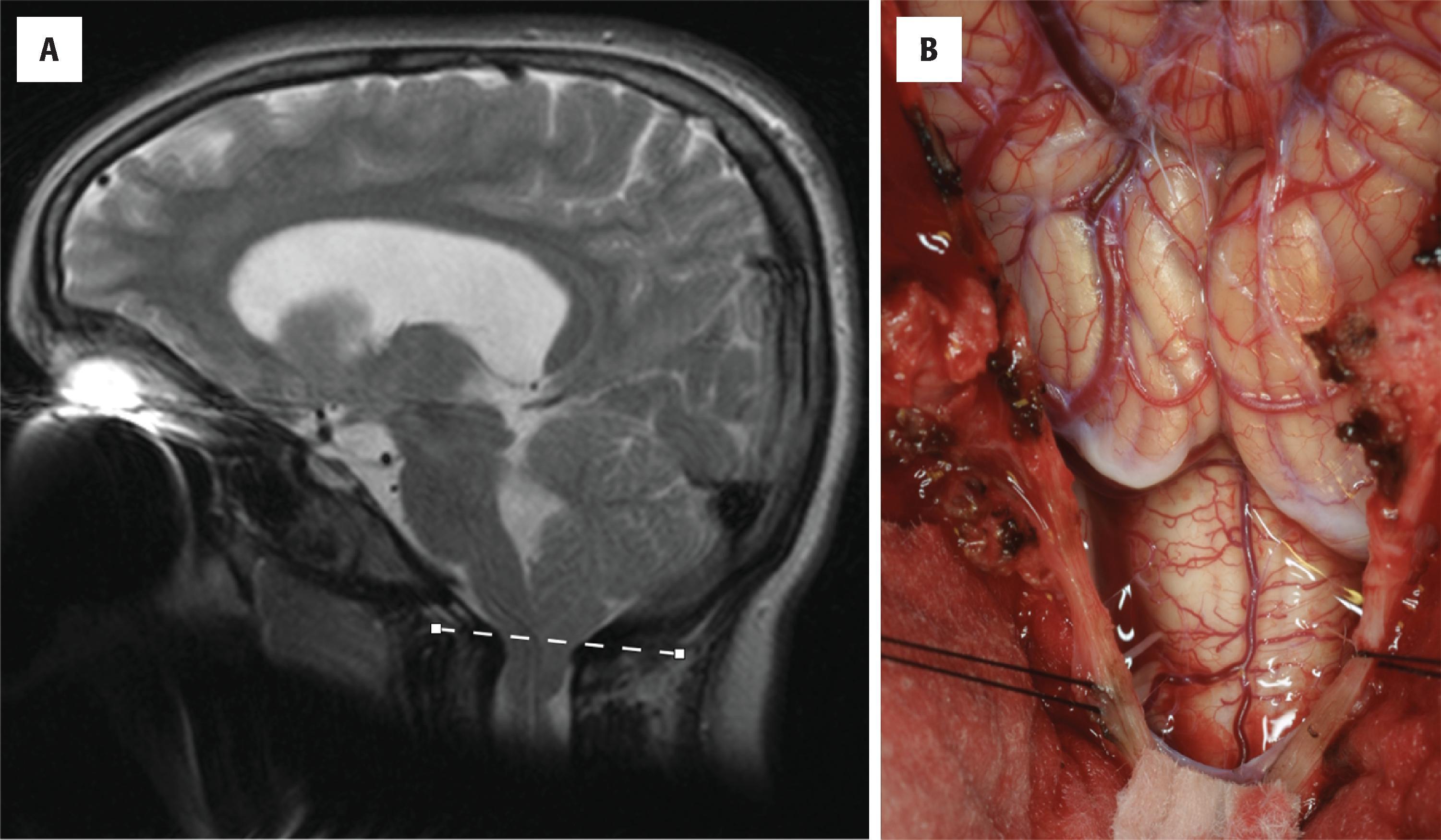 FIGURE 4.50, Chiari I malformation: ( A ) Parasagittal magnetic resonance imaging showing downward displacement of cerebellar tissue through the foramen magnum. The cerebellar tissue covers the dorsal surface of the upper cervical spinal cord. ( B ) Intraoperative view during decompression surgery showing peglike extensions of cerebellar tissue through the foramen magnum.