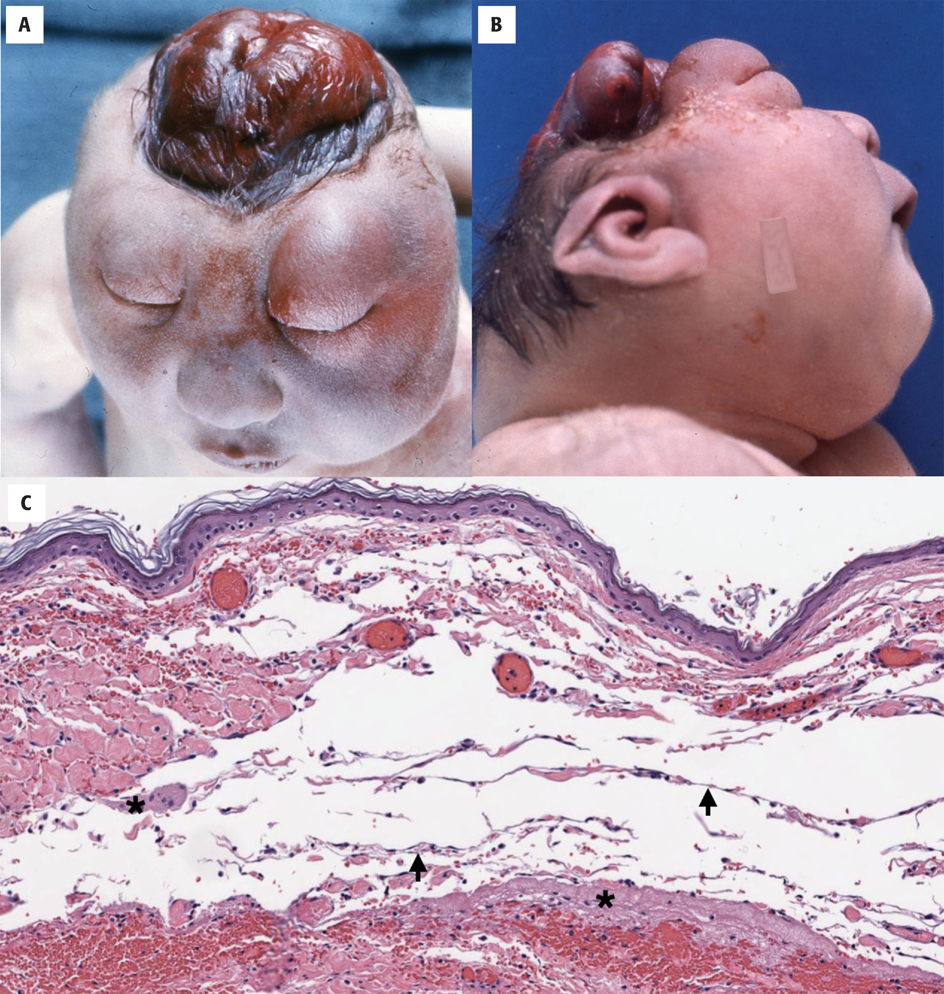 FIGURE 4.5, Anencephaly. ( A and B ) Two different cases with complete absence of the cranial vault and facial dysmorphism including typical prominent protruding eyes. The skull, meninges, and brain are replaced by a highly vascular and congested membranous tissue (area cerebrovasculosa) covering the cranial base. (Courtesy the late Dr. Robert H. Shikes, Denver.) ( C ) Microscopic section through the area cerebrovasculosa illustrating thin keratinized epidermis, atrophic dermis, meningeal tissue ( arrows ), and disorganized neuroglial tissue ( asterisks ).