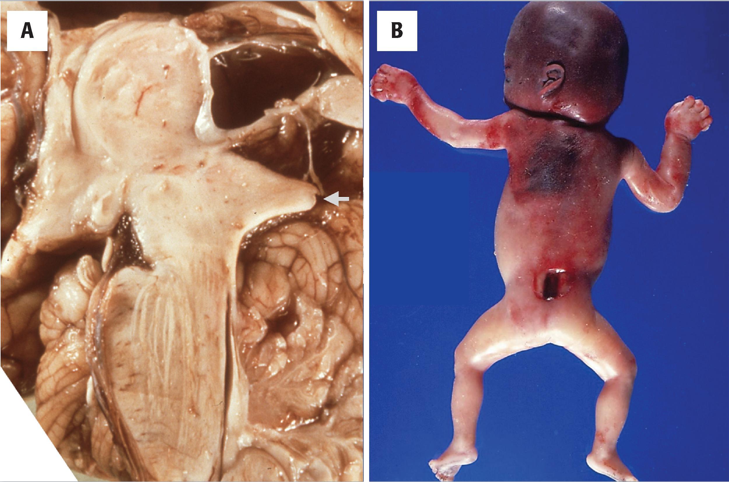 FIGURE 4.51, Chiari II malformation. ( A ) Sagittal section of the brainstem showing tectal beaking ( arrow ) in a case of Chiari II syndrome. Tectal beaking represents dorsal curling of the inferior collicular plate. ( B ) Posterior view of a 20-week fetus with an open spinal defect in the lumbosacral region and enlargement of the head (as a result of hydrocephalus).