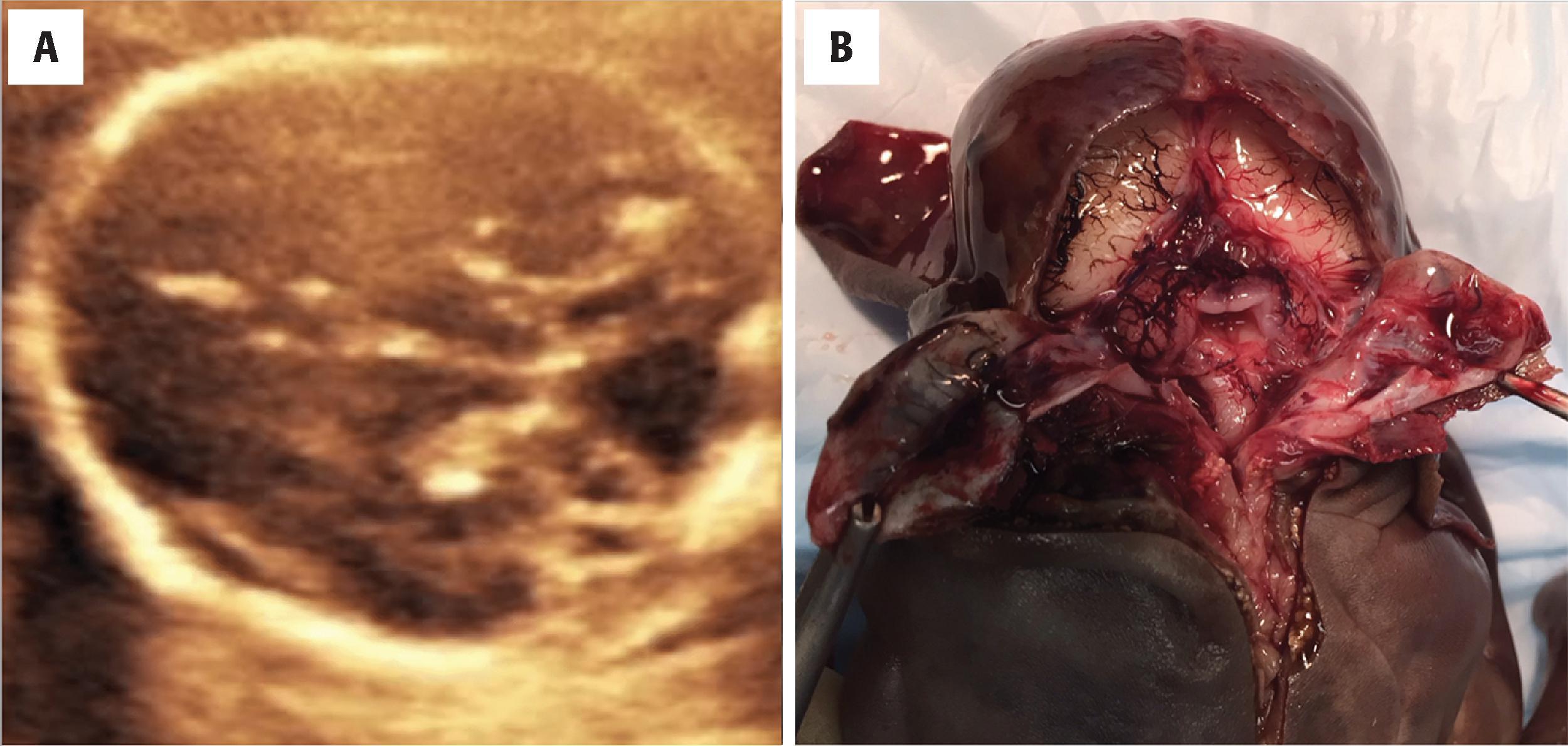 FIGURE 4.52, Dandy-Walker malformation. ( A ) In-utero ultrasound showing cystic dilatation of the fourth ventricle. ( B ) Posterior dissection approach reveals midline cerebellar hypoplasia with intact thin-walled cyst.