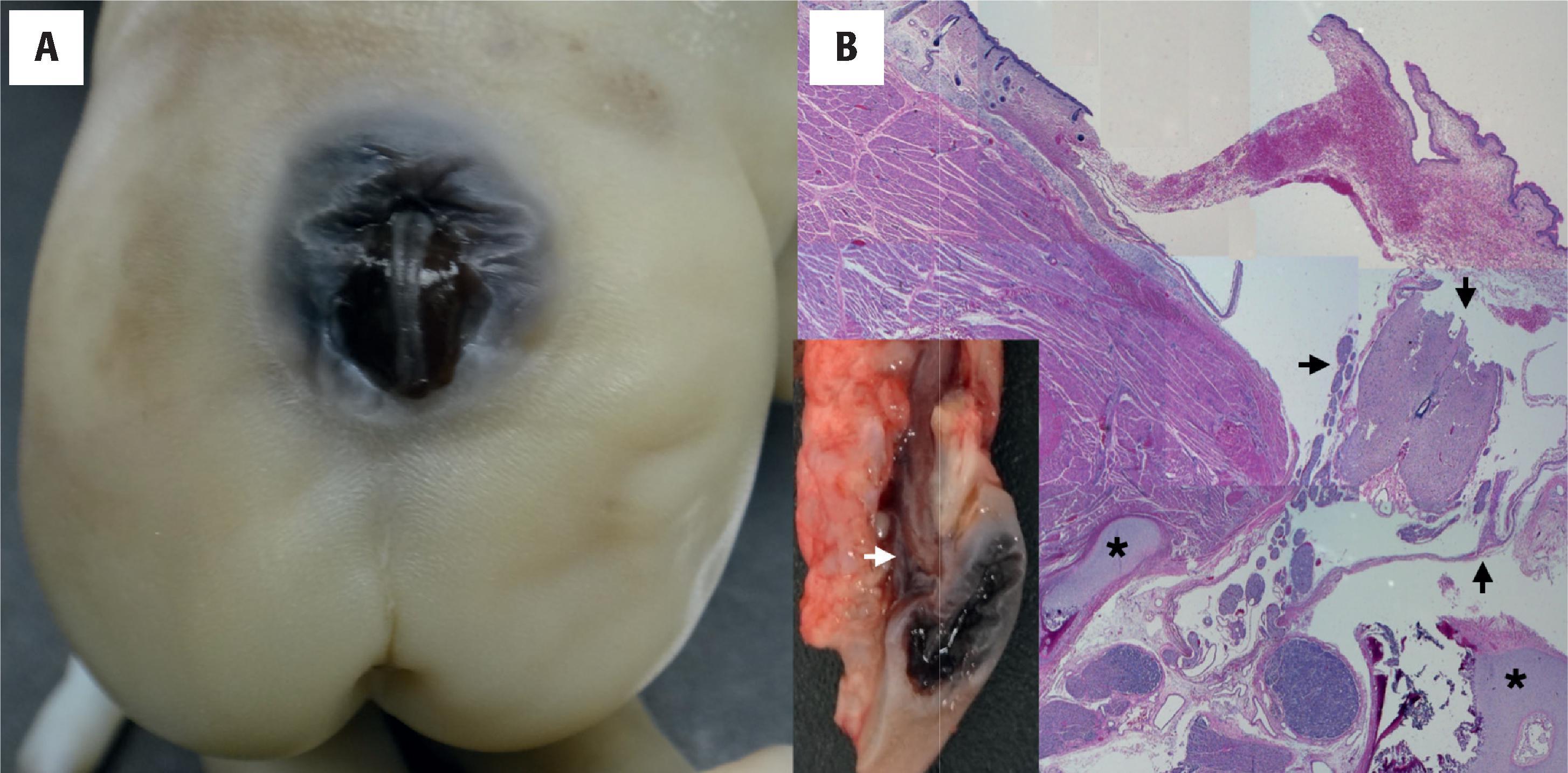 FIGURE 4.6, Myelomeningocele in a 22-week-old fetus. ( A ) Posterior view shows a cystic mass protruding through the dorsally open vertebrae. ( B ) Hematoxylin and eosin–stained section of the same case showing the spinal cord and meninges ( arrows ) lying outside the confines of the open vertebral column. Spinal pedicles ( asterisks ) are seen, but the lamina and spinous process are not present. Inset shows midsagittal dissection specimen with spinal and meningeal tissue ( arrow ) protruding through the skin defect.