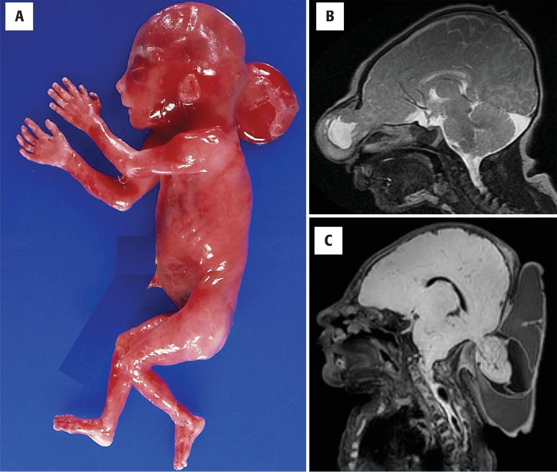 FIGURE 4.7, Encephalocele. ( A ) A second trimester fetus with large posterior (occipital) encephalocele. Notice the presence of polydactyly in the left hand. (Courtesy Dr. Mark Lovell, Denver.) ( B and C ) Sagittal magnetic resonance imaging of term neonates showing a large frontonasal encephalocele ( B ) and an occipital encephalocele ( C ).