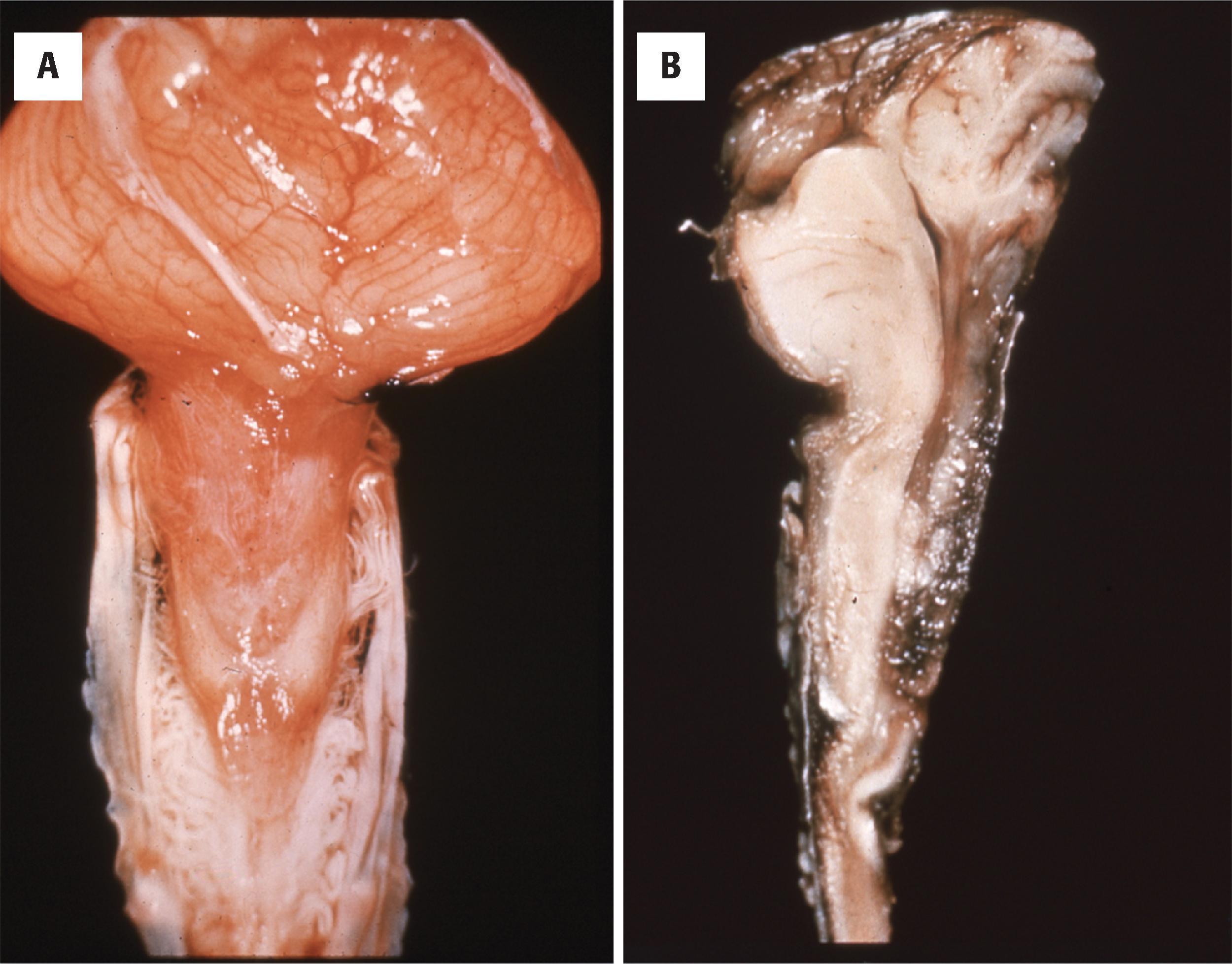 FIGURE 4.9, Chiari II malformation. ( A ) Dorsal view of the brain showing protrusion of the vermis into the cervical spinal cord. The displaced vermis overlies the dorsal cervical spinal cord. ( B ) Midsagittal section showing the cerebellar vermis extending over the dorsal aspect of the cervical spinal cord. Kinking of the medulla is also noticeable.