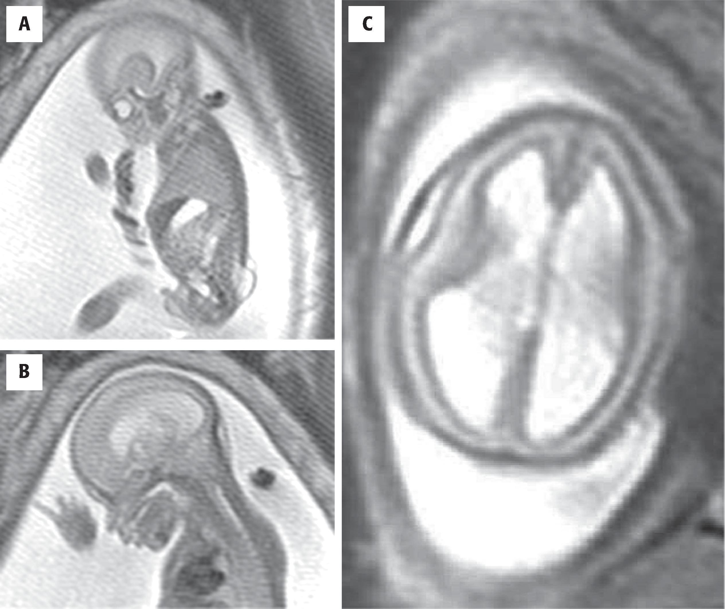 FIGURE 4.10, ( A and C ) Chiari II malformation. ( A ) Fetal brain and spine magnetic resonance imaging (MRI), sagittal view, revealing a lumbosacral myelomeningocele. ( B ) Fetal brain MRI, sagittal view, showing a small posterior fossa with hindbrain crowding and hydrocephalus. ( C ) Fetal brain MRI, axial view, demonstrating ventricular expansion and anteroposterior elongation of the head. (Courtesy Dr. D. Levine, Boston.) ( D ) Chiari III malformation. MRI of a newborn showing midline occipital meningoencephalocele containing a small amount of cerebellar tissue, prominent tectal beaking, and marked enlargement of the lateral ventricles, features consistent with Chiari III malformation.