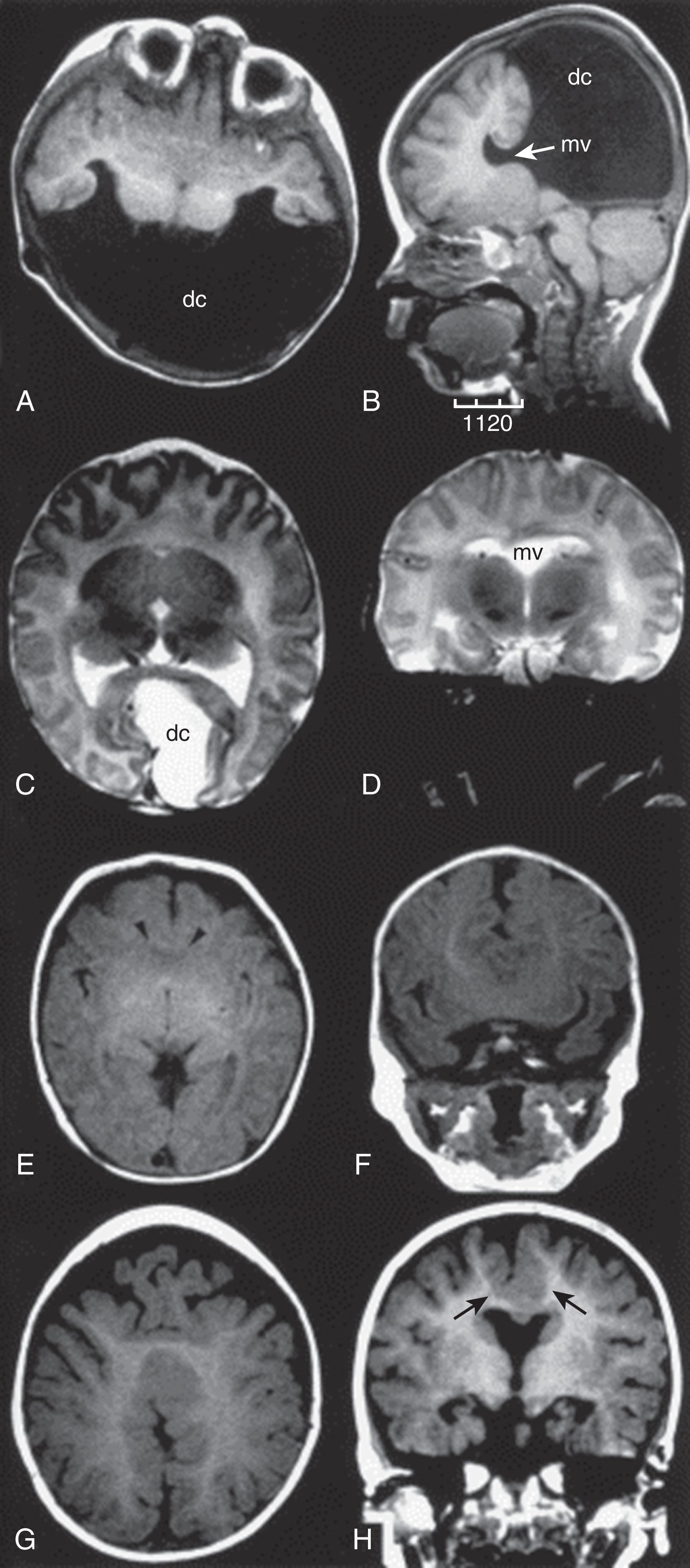 Fig. 53.2, The Spectrum of Holoprosencephaly as Demonstrated by Magnetic Resonance Imaging.