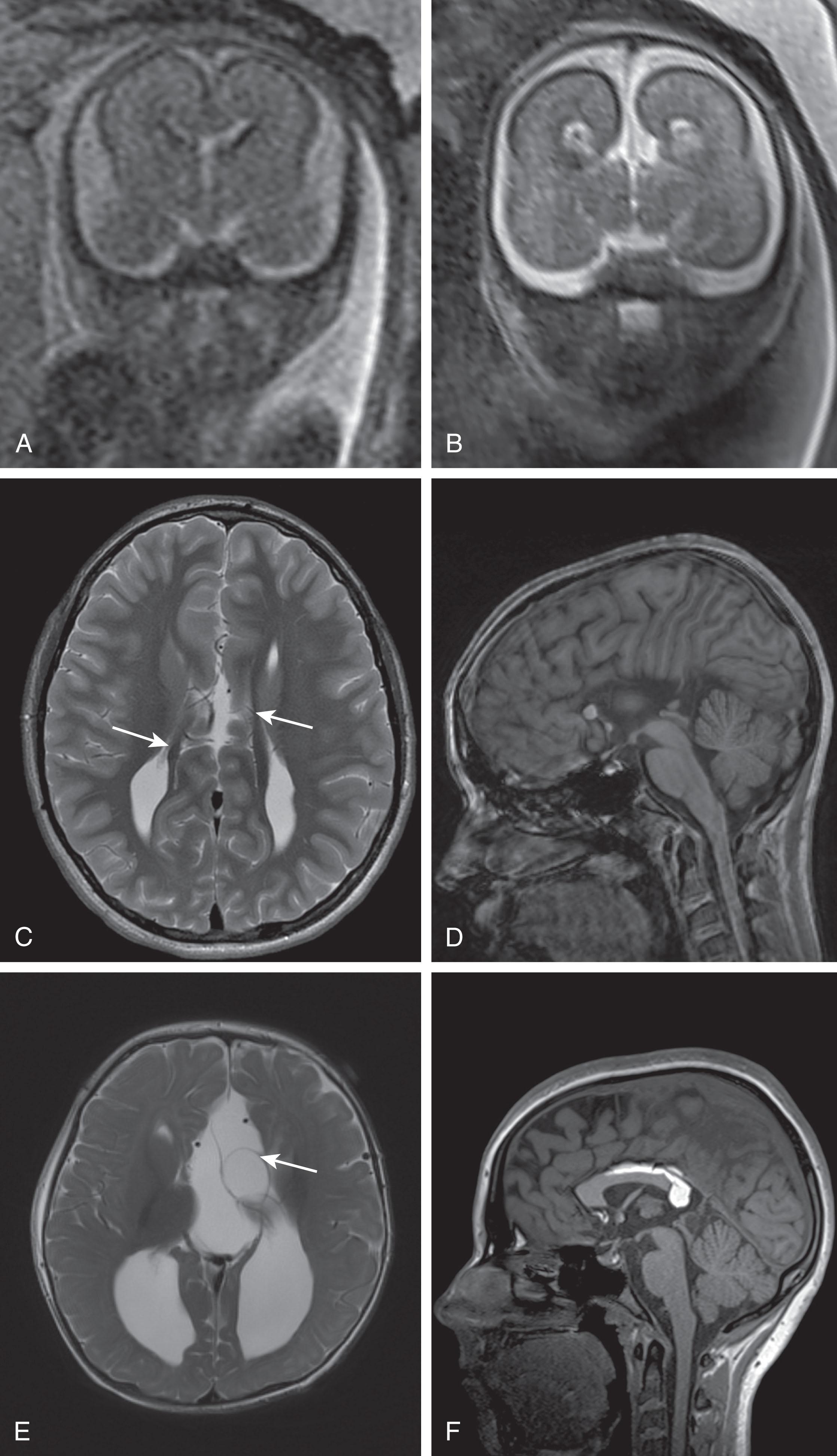 Fig. 53.3, Findings Associated With Agenesis of the Corpus Callosum as Demonstrated by Magnetic Resonance Imaging.