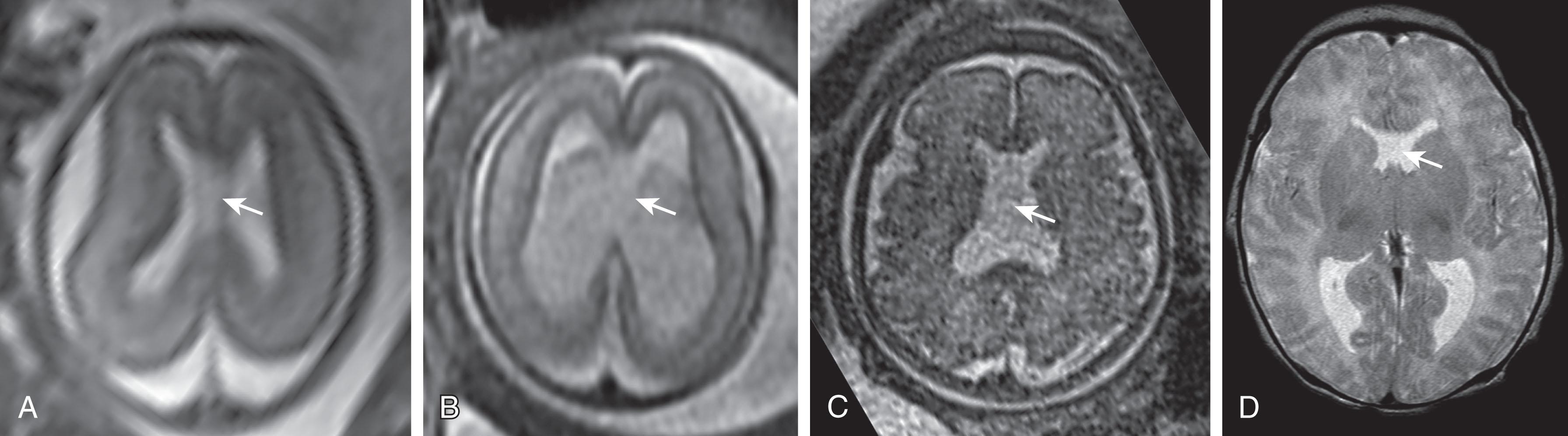 Fig. 53.4, Fetal and Postnatal Magnetic Resonance Imaging With Absent Cavum Septi Pellucidi.