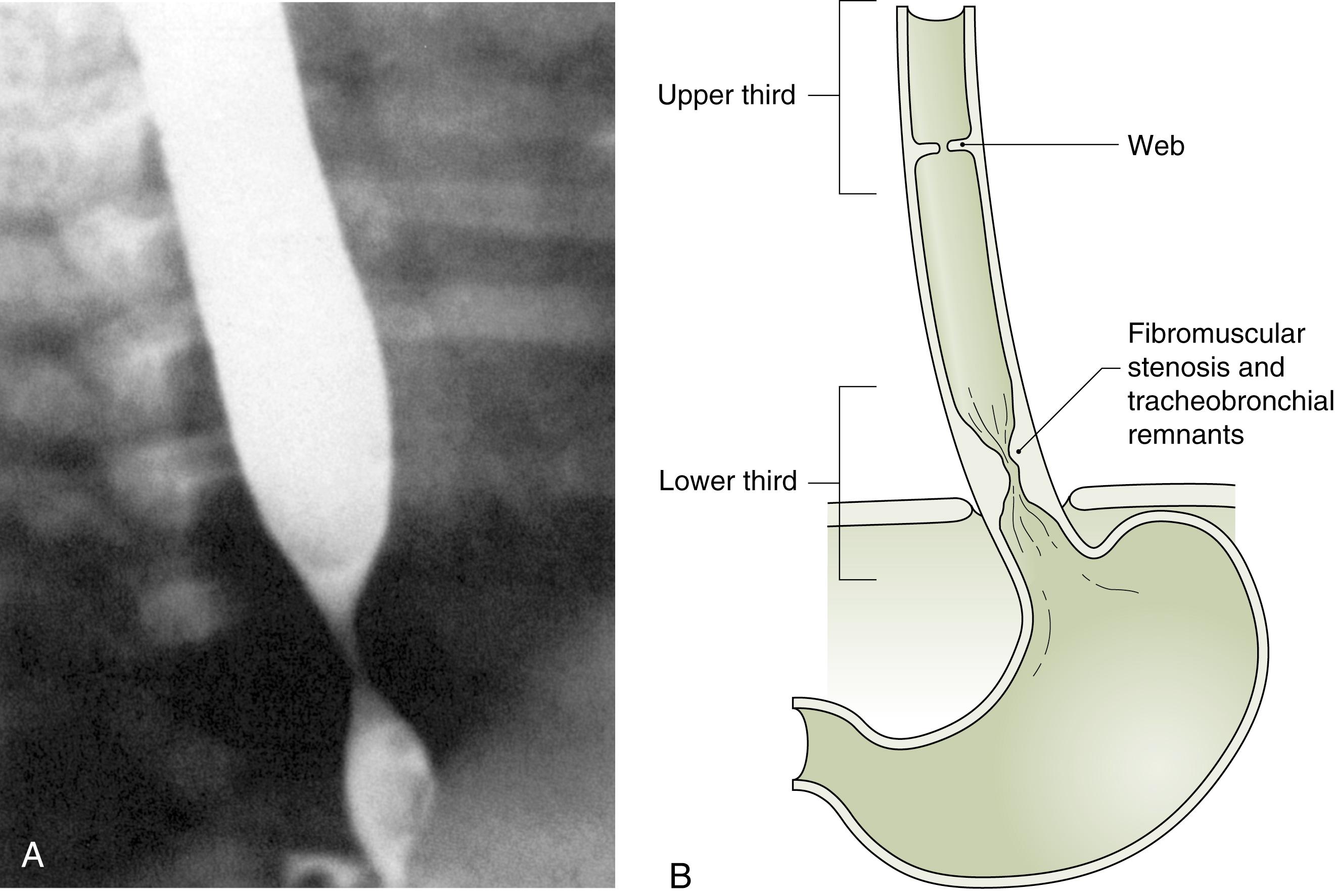 Fig. 20.1, (A) Barium esophagram performed in a 1-month-old infant with dysphagia shows a congenital esophageal stenosis in the distal esophagus and proximal esophageal dilation. This is characteristic of a fibromuscular stenosis or a stenosis from a persistent cartilaginous remnant. (B) The usual location of the common forms of congenital esophageal stenosis: esophageal webs in the upper one-third of the esophagus, and fibromuscular stenosis or persistent cartilaginous tracheobronchial remnants in the distal one-third of the esophagus.