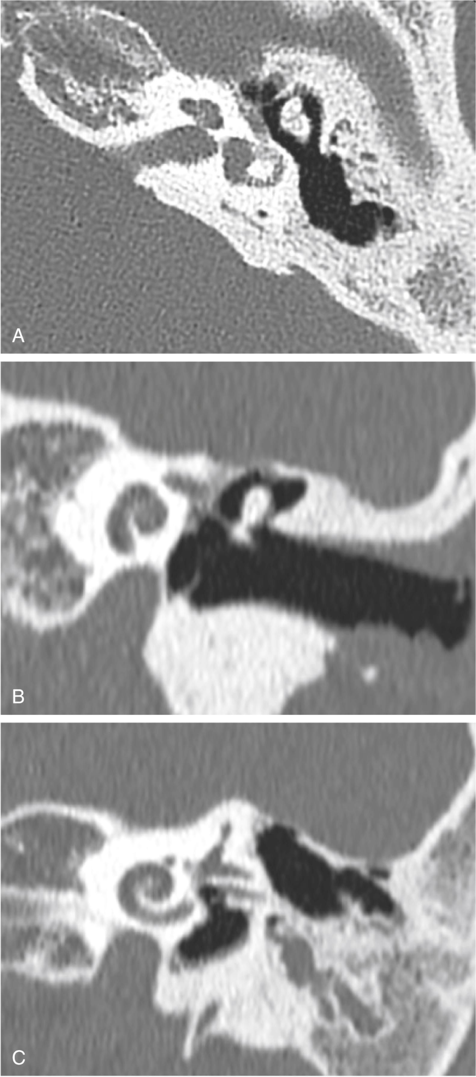 Fig. 13.3, Radiographically normal inner ear as seen on axial (A) coronal (B) and Stenvers view (perpendicular to plane of superior semicircular canal) (C) high-resolution computed tomography scans. Note that the normal cochlea appears to have only 1.5 turns on the coronal scan, as a result of the oblique angle of section in relation to the axial scans of the modiolus.