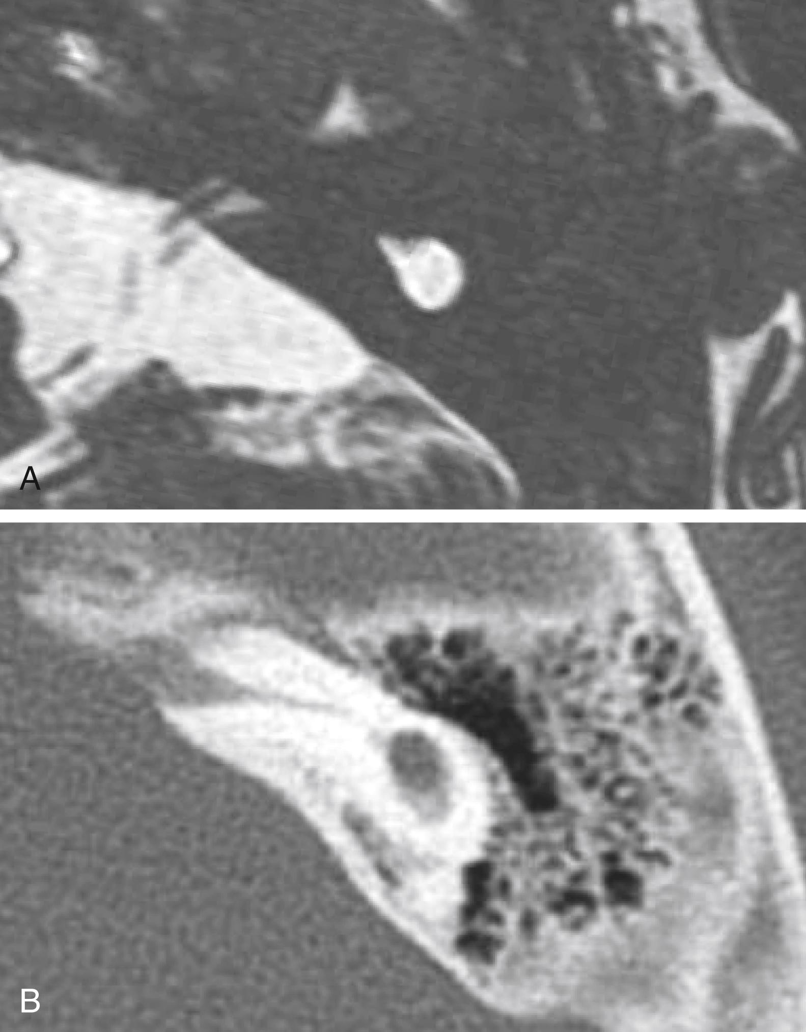 Fig. 13.6, Axial magnetic resonance imaging (A) and computed tomography (B) scans of cochlear aplasia showing a malformed cystic structure posterior to a narrowed internal auditory canal consistent with vestibular dysplasia without obvious semicircular canal formation.