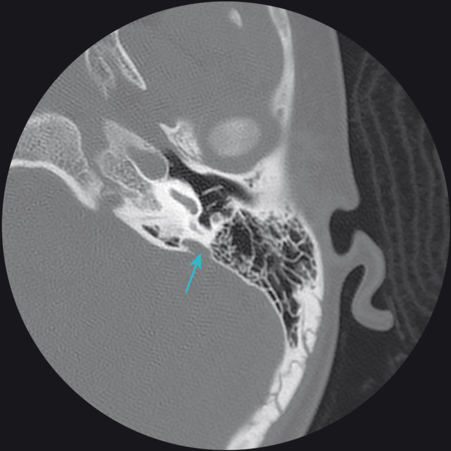 Fig. 204.1, Temporal bone computed tomography of a child with left conductive hearing loss and large vestibular aqueduct (arrow) . Interestingly, the sister also has large vestibular aqueducts and sensorineural hearing loss. No surgery is recommended for this patient.