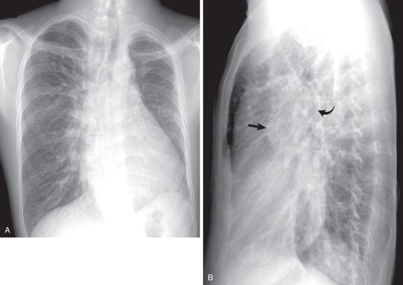 Fig. 8.1, Proximal interruption of the left pulmonary artery. (A) A frontal chest radiograph demonstrates a reduction in left lung volume accompanied by leftward displacement of the trachea and heart. The left pulmonary artery contour is absent, and the left lung shows decreased vascularity and subtle peripheral reticulation. (B) A lateral chest radiograph shows absence of the curvilinear opacity in the left hilum that normally corresponds to the left pulmonary artery (curved arrow); in the right hilum the right hilar vascular opacity is clearly seen (straight arrow).