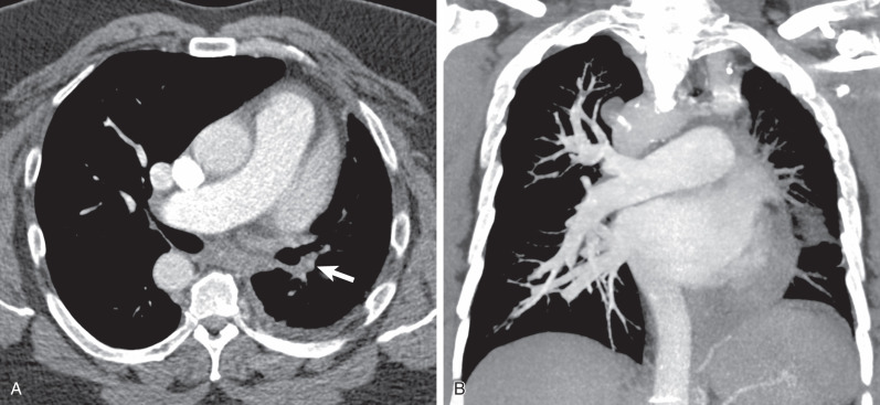 Fig. 8.2, Proximal interruption of the left pulmonary artery. (A) Axial CT image shows absence of the left pulmonary artery, with diminutive left lower lobar pulmonary artery and branches (arrow). A right aortic arch is present, after the expectation that the aortic arch is contralateral to the side of the interruption. The left lung is small, and the pleura is mildly thickened. (B) Coronal reformatted maximum-intensity projection image shows interruption of the left pulmonary artery, with enlargement of the right pulmonary artery and its branches.