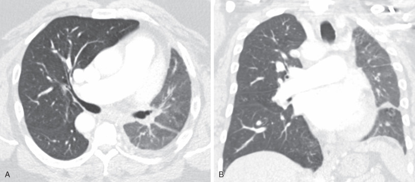 Fig. 8.3, Proximal interruption of the left pulmonary artery; same patient as Fig. 8.2 , shown in lung windows. (A) and (B) Axial and coronal reformatted CT images show a small left lung with leftward mediastinal shift. Note left lung mosaic attenuation, peripheral reticulation, and pleural thickening, a common appearance on the side of the interrupted pulmonary artery resulting from chronic pulmonary arterial malperfusion and the abnormal systemic collateral circulation.