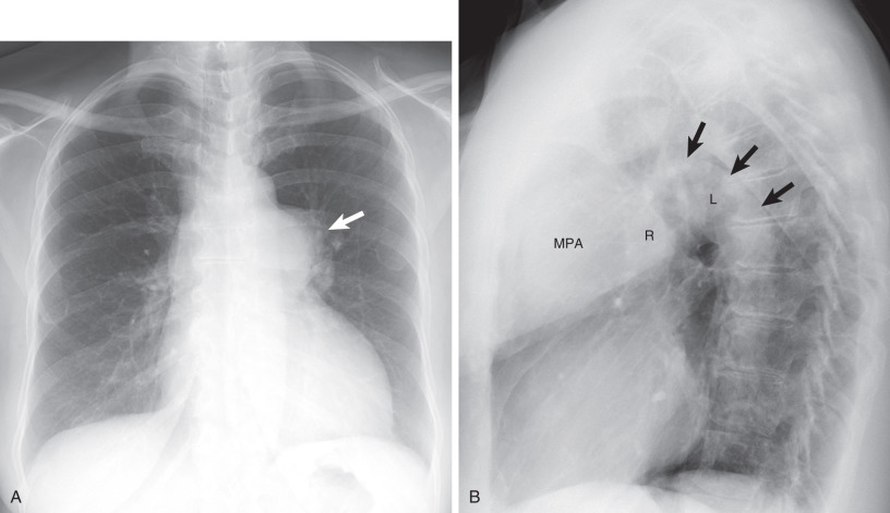 Fig. 8.4, Pulmonary valvular stenosis. (A) Frontal chest radiograph shows enlargement of the main and left pulmonary arteries (arrow); the right pulmonary artery is of normal size. (B) Lateral chest radiograph shows an enlarged main pulmonary artery (MPA), an enlarged left pulmonary artery ( L and arrows ), and a normal size of the right hilar vascular opacity (R). (C) Steady-state–free precession (SSFP) image through the central pulmonary arteries shows selective enlargement of the main pulmonary artery and the proximal left pulmonary artery (LPA); the right pulmonary artery (RPA) is normal in size. (D) Sagittal SSFP cine MR image through the right ventricular outflow tract shows a severely enlarged main pulmonary artery (PA) and a spin-dephasing jet (arrow) corresponding to flow acceleration from pulmonic valve stenosis. (E) Oblique reformatted CT image shows thickened leaflets of the pulmonic valve in keeping with pulmonic stenosis (curved arrow) . An aneurysmal aortic root (Ao) is also noted. (F) Sagittal reformatted CT image shows thickening of the pulmonic valve leaflets (black arrow), with a domed appearance of the basal leaflets. Right ventricular hypertrophy is present (white arrows).