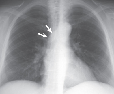 Fig. 8.5, Aberrant retrotracheal left pulmonary artery (pulmonary artery sling). A chest radiograph performed for evaluation of moderate dyspnea shows an abnormal opacity in the right tracheobronchial angle (arrows) , proven to represent a pulmonary artery sling.