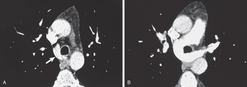 Fig. 8.6, Aberrant retrotracheal left pulmonary artery (pulmonary artery sling): CT findings. (A) CT image at the level of the upper left pulmonary artery (arrow), which courses around the right lateral and posterior aspects of the morphologically normal trachea. (B) CT image at a slightly more caudal level demonstrating the entire course of the left pulmonary artery. It arises from the posterior, proximal right pulmonary artery, passes between the trachea and esophagus, and then courses toward the left hilum. A comparison of tracheal sizes shows that the trachea has a slightly smaller diameter in (B) than at the higher level (A).