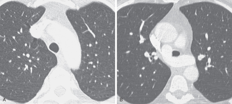 Fig. 8.7, Aberrant retrotracheal left pulmonary artery (pulmonary artery sling): CT findings. CT images at the level of the aortic arch (A) and at the level of the aberrant pulmonary artery (B) again demonstrate the reduction in diameter of the trachea at the level of the ectopic pulmonary artery. Both cases (see Figs. 8.6 and 8.7 ) represent “ring-sling” syndromes.