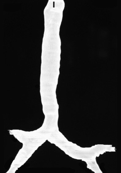 Fig. 8.8, Tracheal stenosis caused by an aberrant retrotracheal left pulmonary artery (pulmonary artery sling). Volumetric reconstruction of the tracheal bifurcation demonstrates moderate stenosis of the distal trachea. This type of stenosis, which is smoothly tapered with respect to the proximal trachea, can easily go undetected during bronchoscopy.