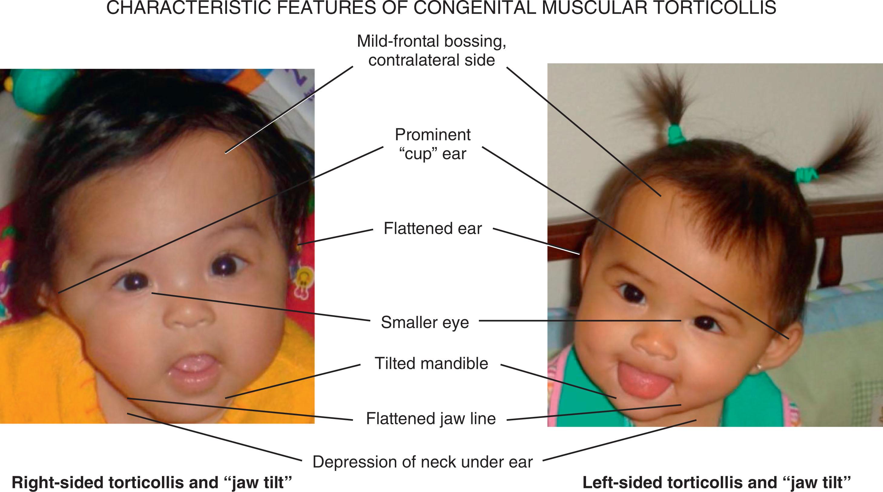 FIGURE 24.1, Examples of the subtle characteristic facial features secondary to right- and left-sided torticollis.