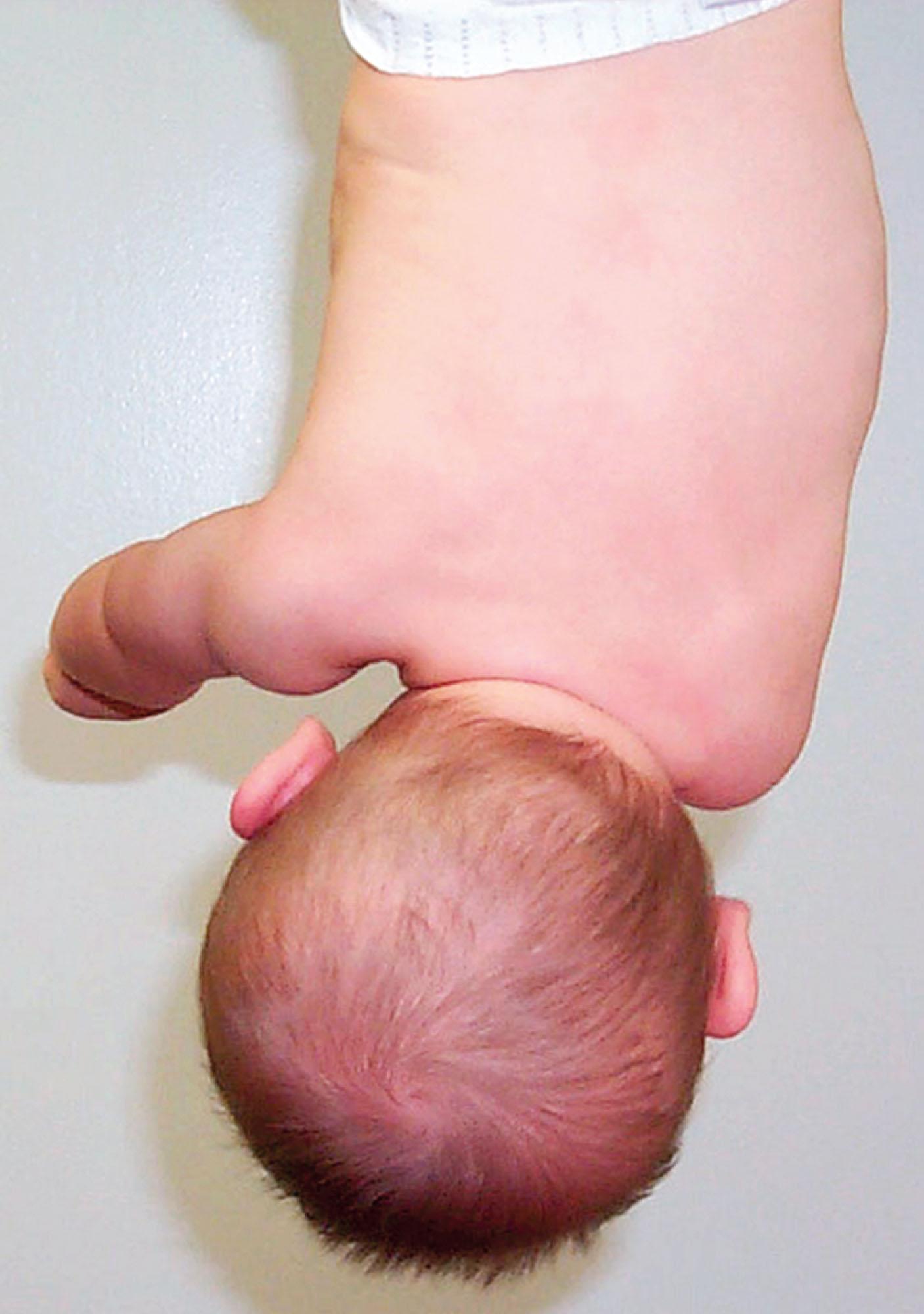 FIGURE 24.2, When a young infant is suspended upside down by holding the feet and ankles securely above an examination table, any generalized tightness of the neck or trunk musculature will cause the infant’s neck and body to curve toward the tight side. This infant suspension test can be used to monitor the course of physical therapy, and it will often show differences between multiple gestation infants according to the degree of late gestational constraint each fetus experienced. Normally, an infant with no muscular asymmetry should hang straight down like a plumb bob. This infant has left congenital muscular torticollis with associated curvature of the trunk (idiopathic infantile scoliosis) and mild deformational posterior plagiocephaly. The coexistence of turned head, adduction contracture of the hip, and truncal curvature, TAC, syndrome suggests the specific intrauterine asymmetric posture of this infant as a fetus. He responded well to physical therapy with repositioning.