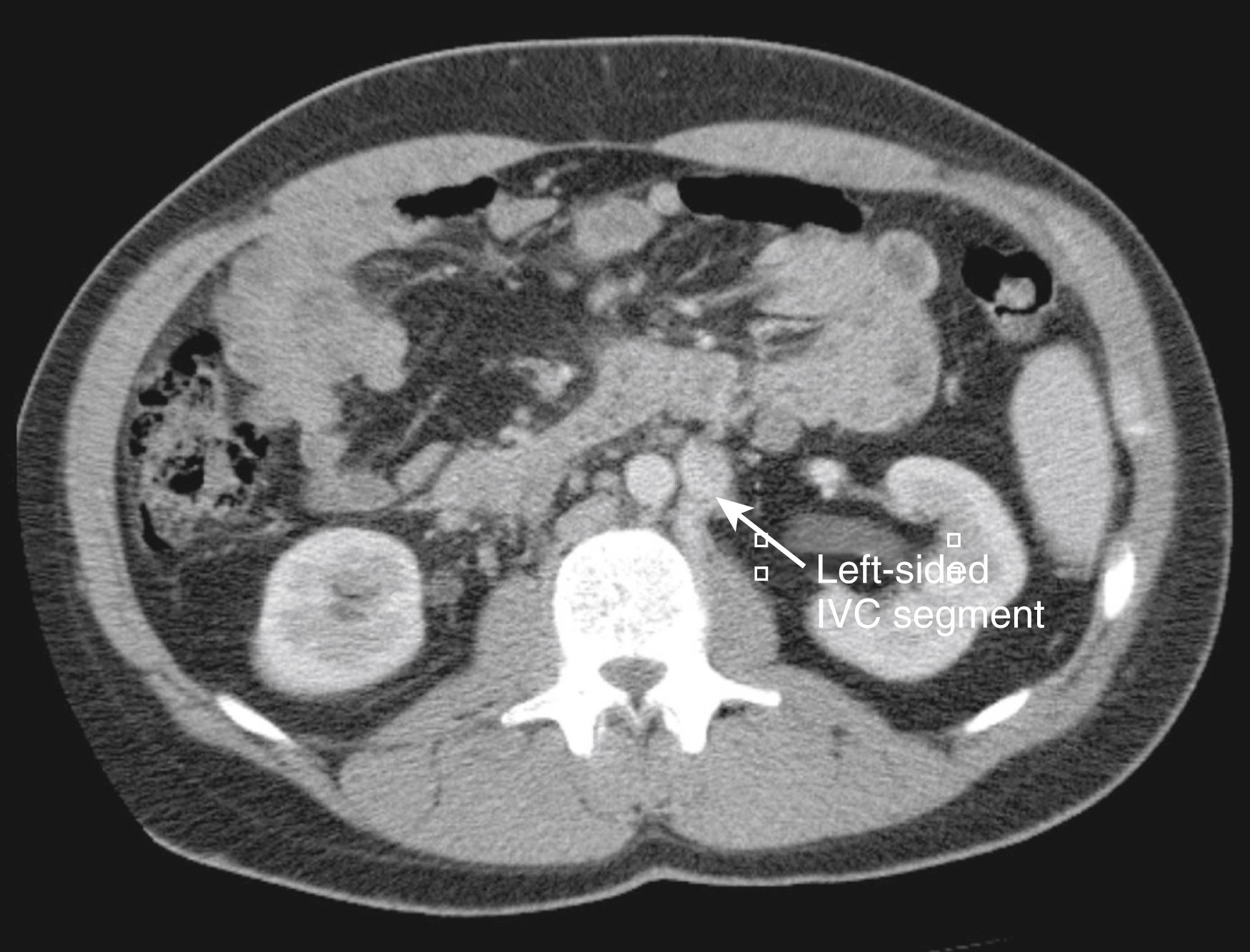 Figure 163.1, Computed tomography scan demonstrating left-sided infrarenal inferior vena cava (IVC) with an absent suprarenal IVC.