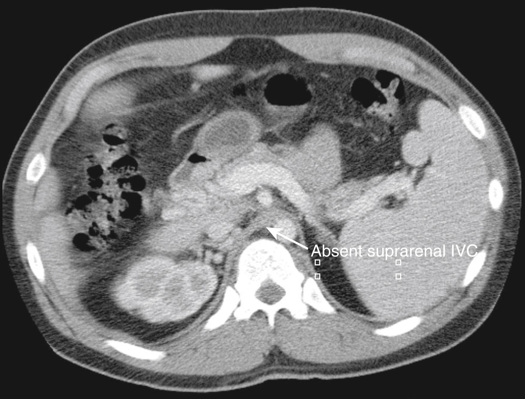 Figure 163.2, Computed tomography scan demonstrating an absent suprarenal inferior vena cava (IVC).