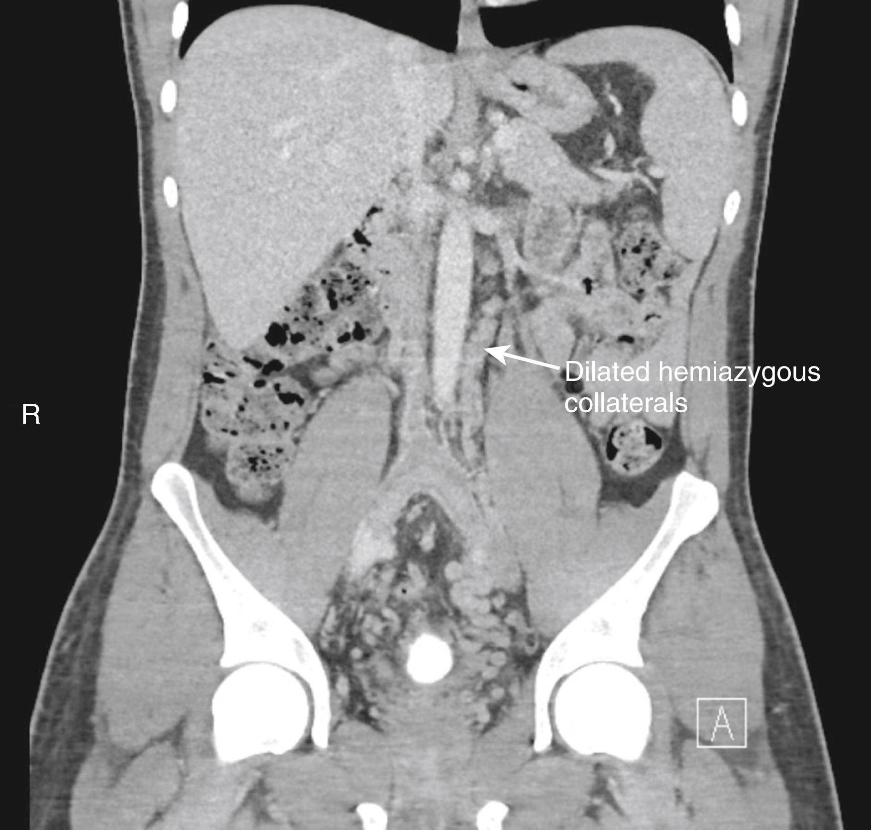 Figure 163.3, Coronal image of computed tomography scan showing hemiazygos continuation of an absent inferior vena cava.