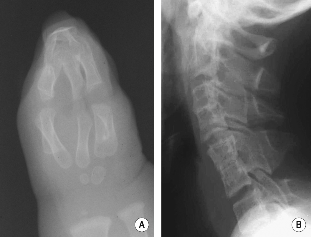 (A) Apert's syndrome. Radiograph of the hand. ‘Mitten’ polysyndactyly of soft tissues and bones. (B) Apert's syndrome. Lateral radiograph of the cervical spine. Progressive fusion of the cervical spine is a recognized feature of this condition. ©35