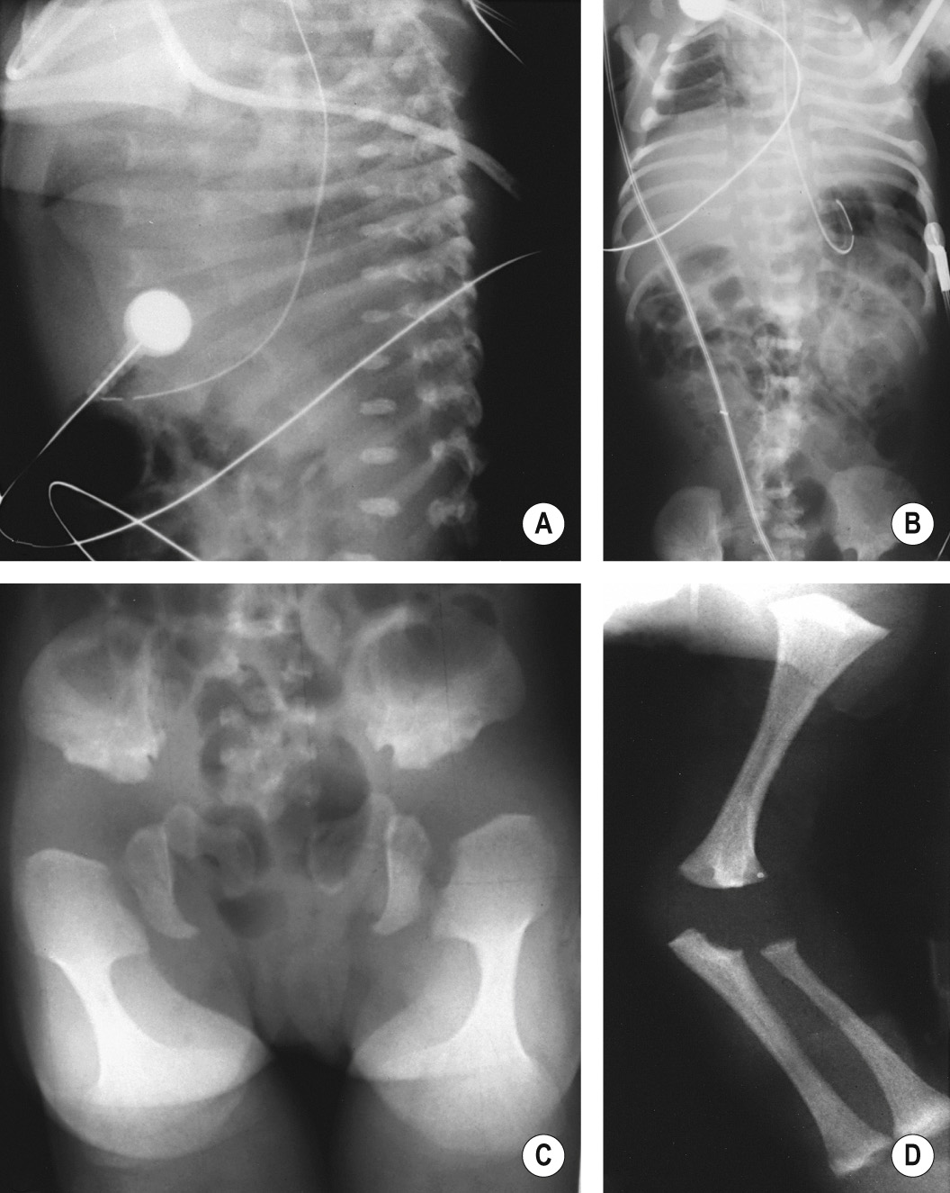 Radiographs in a newborn with metatropic dysplasia. (A) Spine: dense vertebral bodies and short ribs with anterior splaying. (B) Thorax: long trunk and small chest. (C) Pelvis: short iliac wings, narrow sciatic notches, irregular acetabular roofs and halberd (hunting ax)-shaped with trumpet-shaped metaphyses. (D) Upper extremities: flared proximal humeral and distal radial and ulnar metaphyses ▸ shortened long bones. ©24