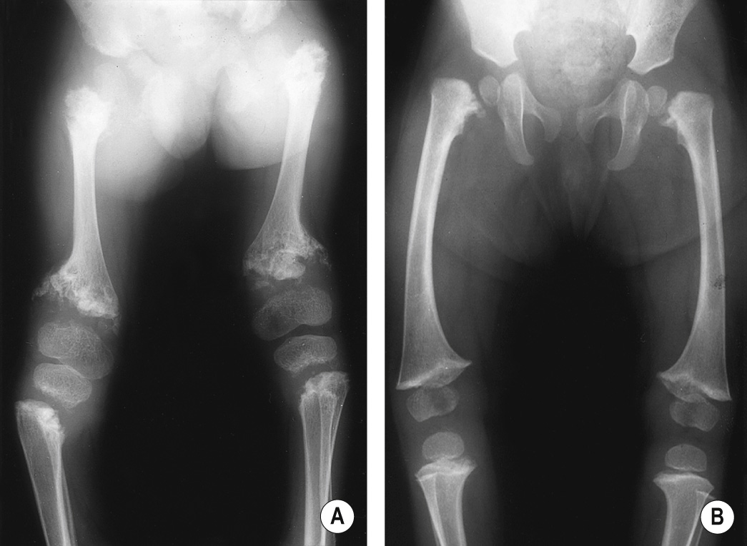 Metaphyseal chondrodysplasia (A) Jansen type. Femora are short with marked expansion, irregular ossification and some sclerosis of the metaphyses. Epiphyses are large and rounded. (B) Schmid type. There is bilateral coxa vara, the metaphyses are splayed and irregular and there is lateral bowing of the femora. *