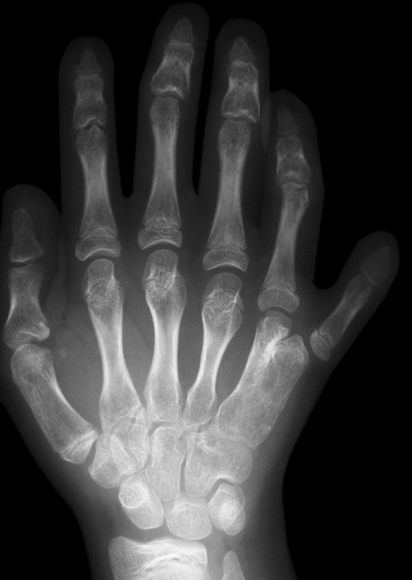 Postaxial polydactyly in a patient with chondroectodermal dysplasia (Ellis-van Creveld syndrome). The plain radiographs show an extra digit on the ulnar side of the right hand. Note also bony fusion of the fifth metacarpal digit and the metacarpal of the extra digit (bony syndactyly). ©35