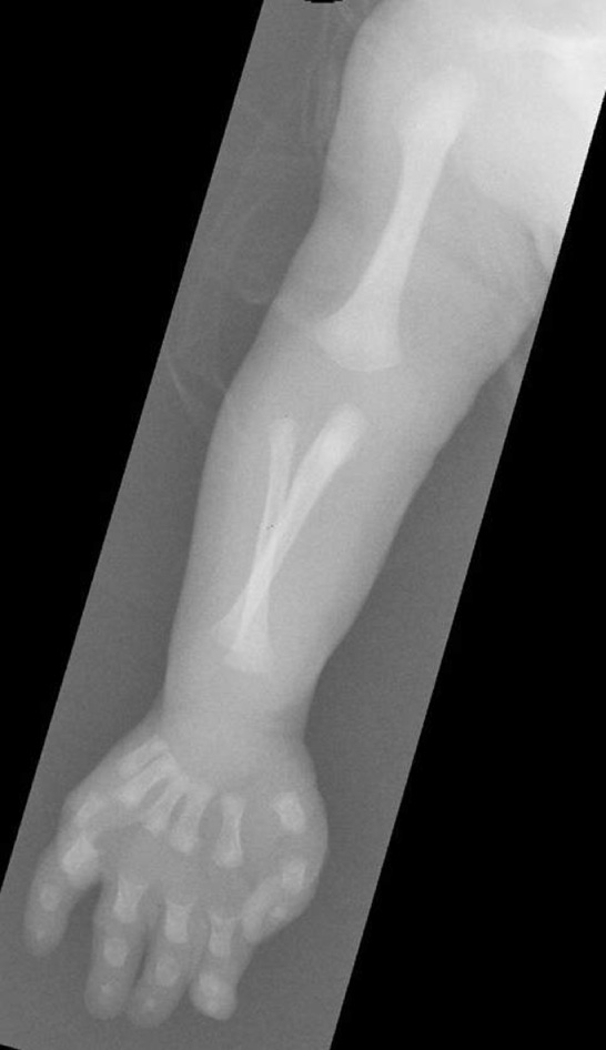 Ellis–van Creveld syndrome. Postaxial polydactyly, short middle and terminal phalanges, cupped metaphyses (the epiphyses will be cone-shaped when they ossify) and sloping of the proximal humeral metaphysis. **