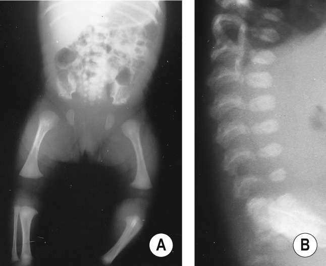 Spondyloepiphyseal dysplasia congenita in a neonate. (A) Absent ossification of the pubic rami, short femoral necks and absent ossification of the epiphyses at the knees. (B) ‘Pear-shaped’ vertebral bodies with posterior constriction. *