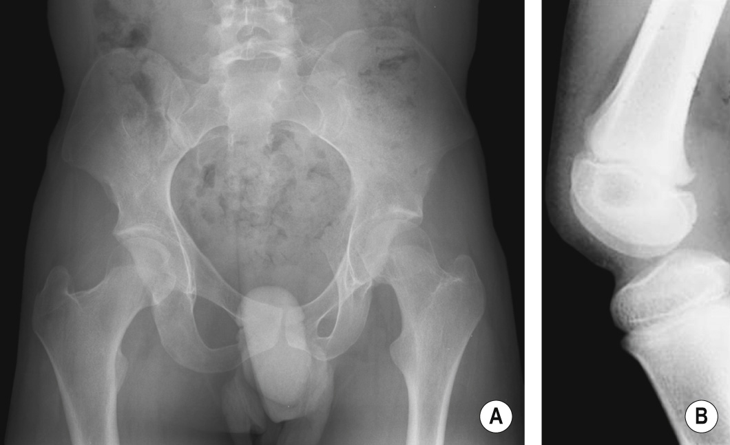 Nail-patella syndrome. (A) Radiograph of the pelvis showing hypoplastic pelvic wings (more pronounced on the right side) and a small iliac horn on the right ilium. (B) Lateral knee radiograph. Note absence of the patella bone. ©35