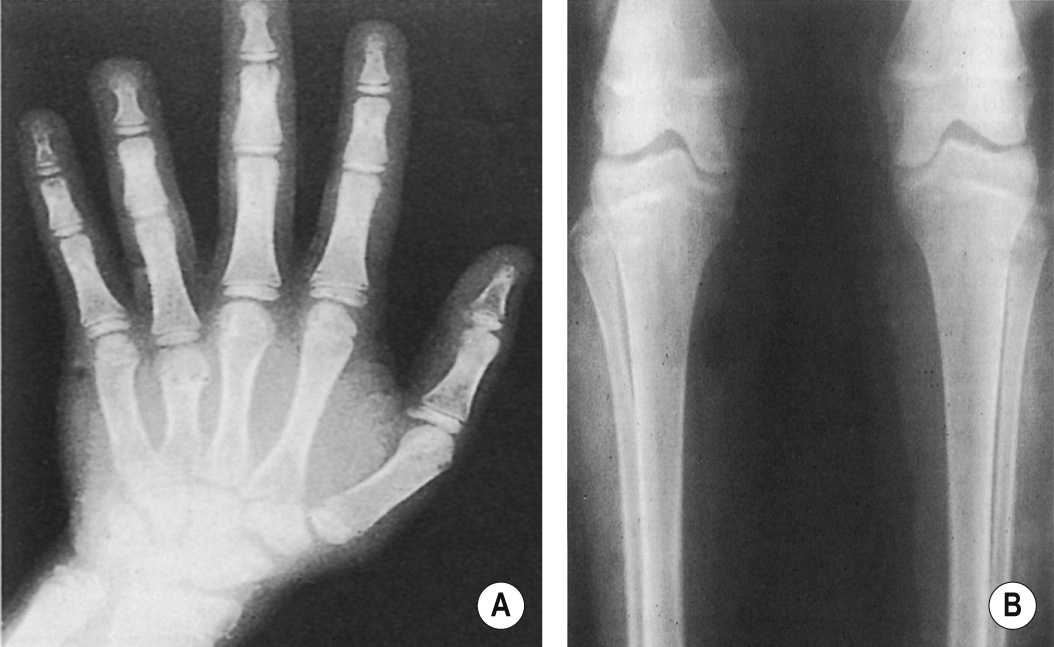 Turner's syndrome. (A) Typical shortening of fourth metacarpals. (B) The medial tibial plateau is depressed and the adjacent femoral condyle enlarged. †