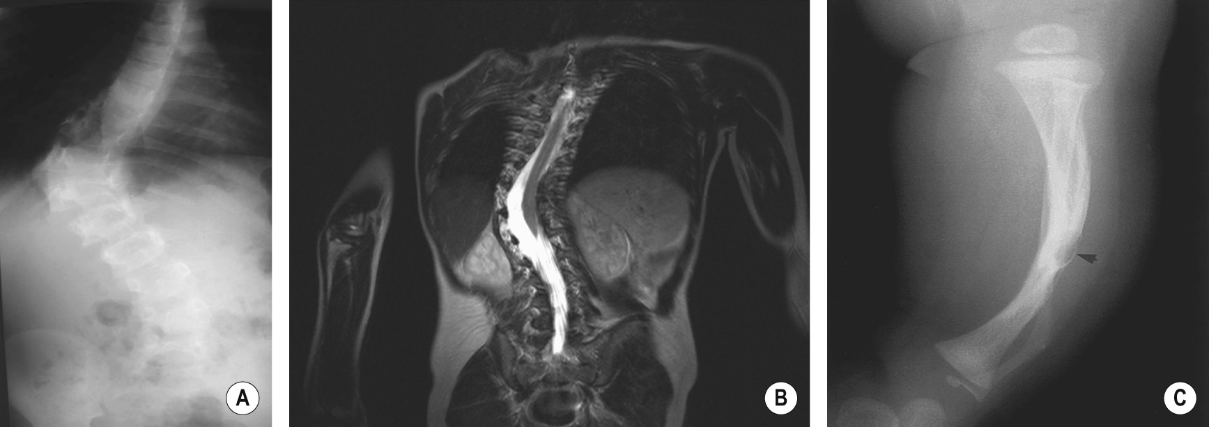 Type 1 neurofibromatosis with a short angular thoracolumbar curve as seen on an anteroposterior radiograph (A) and coronal T2-weighted MR image (B). There is scalloping of the posterior vertebral body wall and enlargement of the exit foramen. The MR image demonstrates dural ectasia with a widened spinal canal. (C) A cystic lesion (arrow) in the tibia at the prefracture stage. The distal fibula is dysplastic and bowed. ©35 , ©34