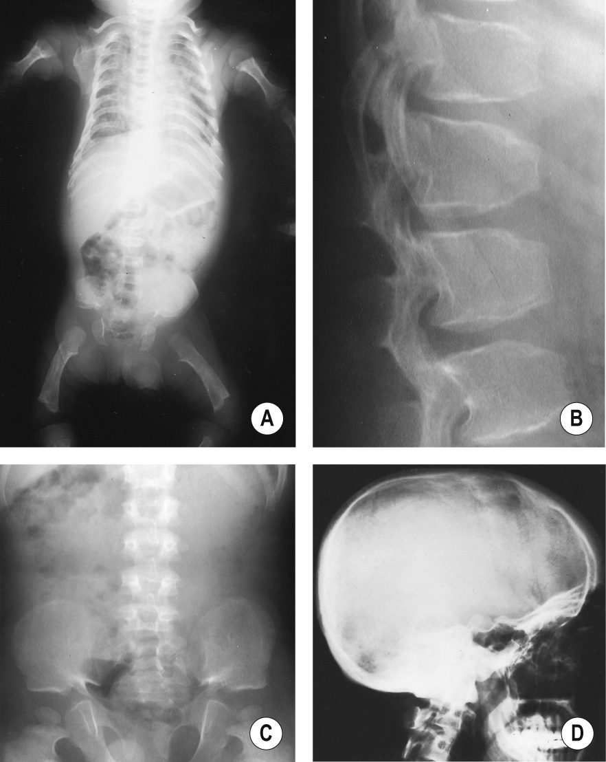 Achondroplasia in a neonate. (A) Sloping metaphyses, oval transradiant proximal femora and a narrow thorax with short ribs. (B) Mild kyphosis, posterior scalloping of the vertebral bodies, ‘bullet-shaped’ vertebral bodies and short pedicles with associated spinal stenosis. (C) Small square iliac wings, horizontal acetabular roofs, short sacrosciatic notches, progressive caudal narrowing of the lumbar interpedicular distances and low-set sacrum. (D) Short skull base with prominent frontal bone and narrow cervical canal. *