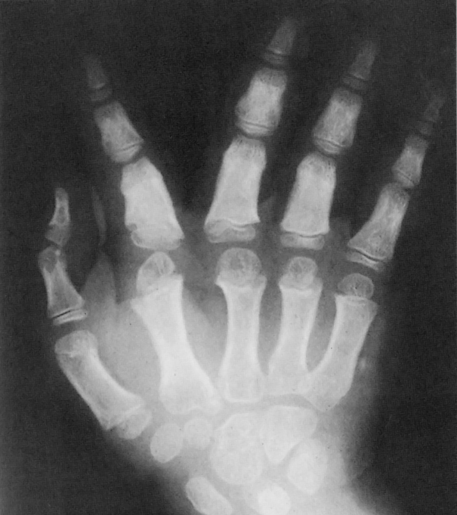 Trident hand in achondroplasia. †