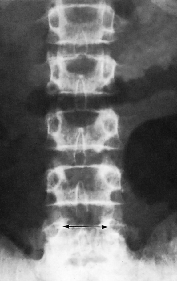 Hypochondroplasia. A narrowed interpedicular distance at L5. †