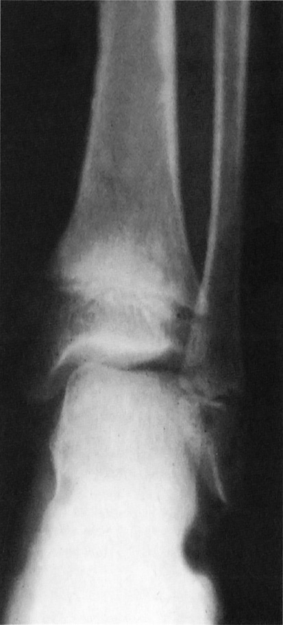 Overgrowth of the distal fibula in hypochondroplasia. †
