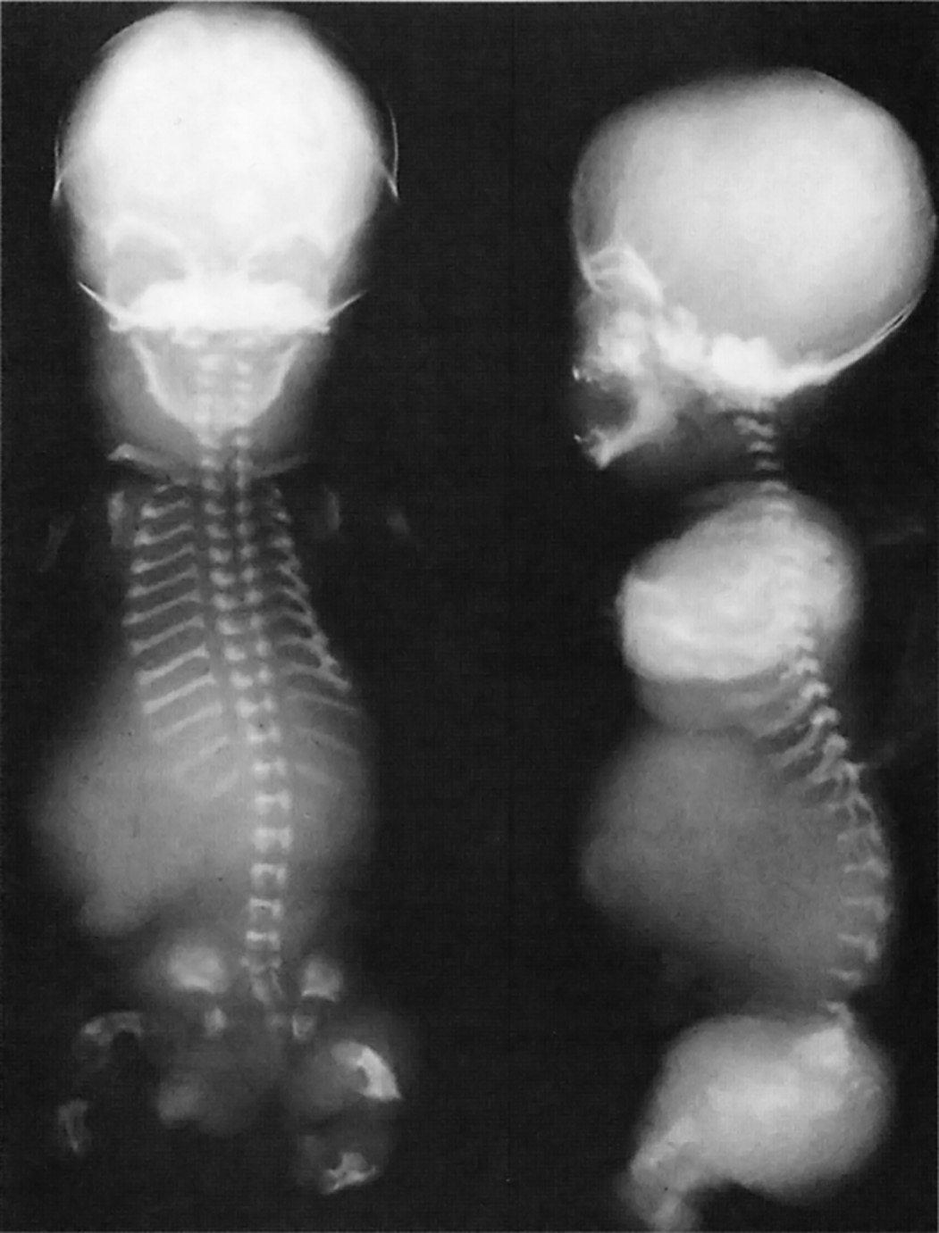 Thanatophoric dwarfism. A cloverleaf skull is present. The scapulae are hypoplastic and the clavicles high. Platyspondyly is shown, resulting in H-shaped vertebral bodies. The bones are short and bowed. †