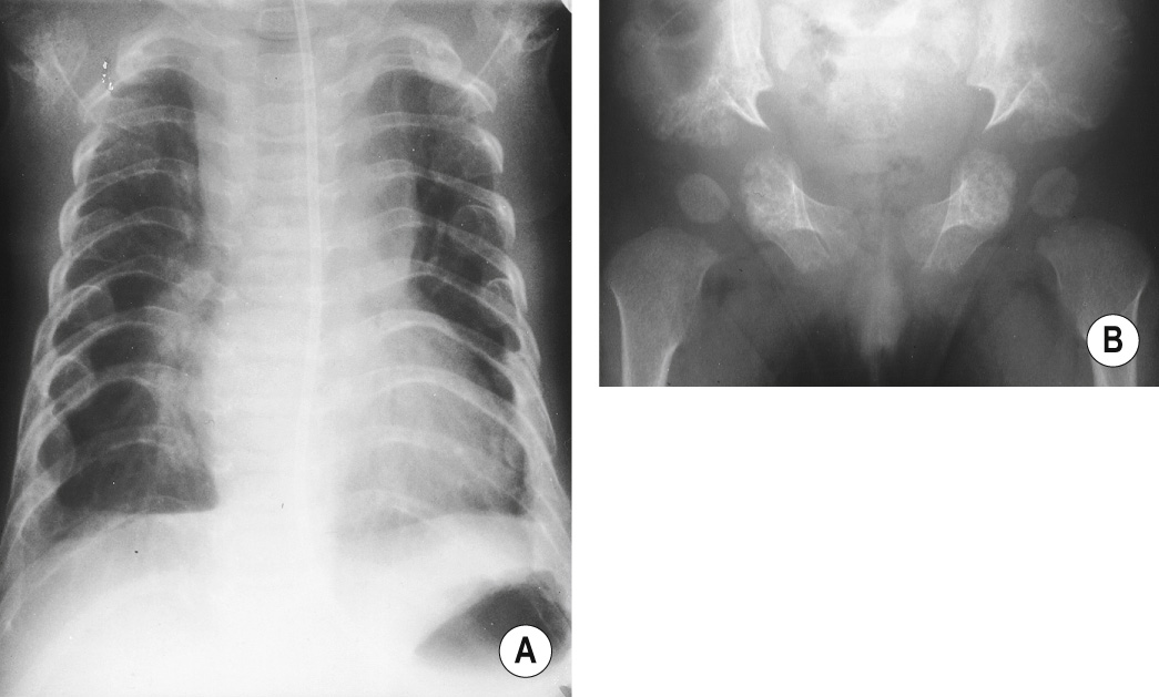 Asphyxiating thoracic dystrophy. (A) Narrow thorax and short ribs. (B) Horizontal acetabular roofs and pronounced medial spurs, less pronounced laterally (‘trident’ appearance). *